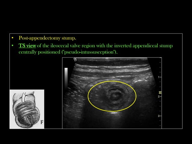 Emergency Ultrasound Course -Lecture 04 -Acute Appendicitis -Part 3 ...