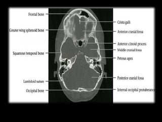 Uncus Radiopaedia Radiological anatomy of the brain 1.pptx