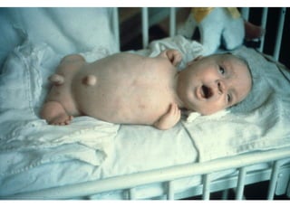 Destructive Birth Hiroshima Radiation Birth Defects