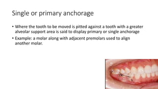 lecture_05_and_06-Anchorage_in_orthodontics[1].pptx