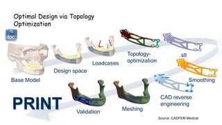 Optimal Design via Topology
Optimization
Base Model
Design space
Loadcases
Topology-
optimization
Smoothing
.stl
CAD reverse
engineering
Meshing
Validation
Source: CADFEM Medical
PRINT
 