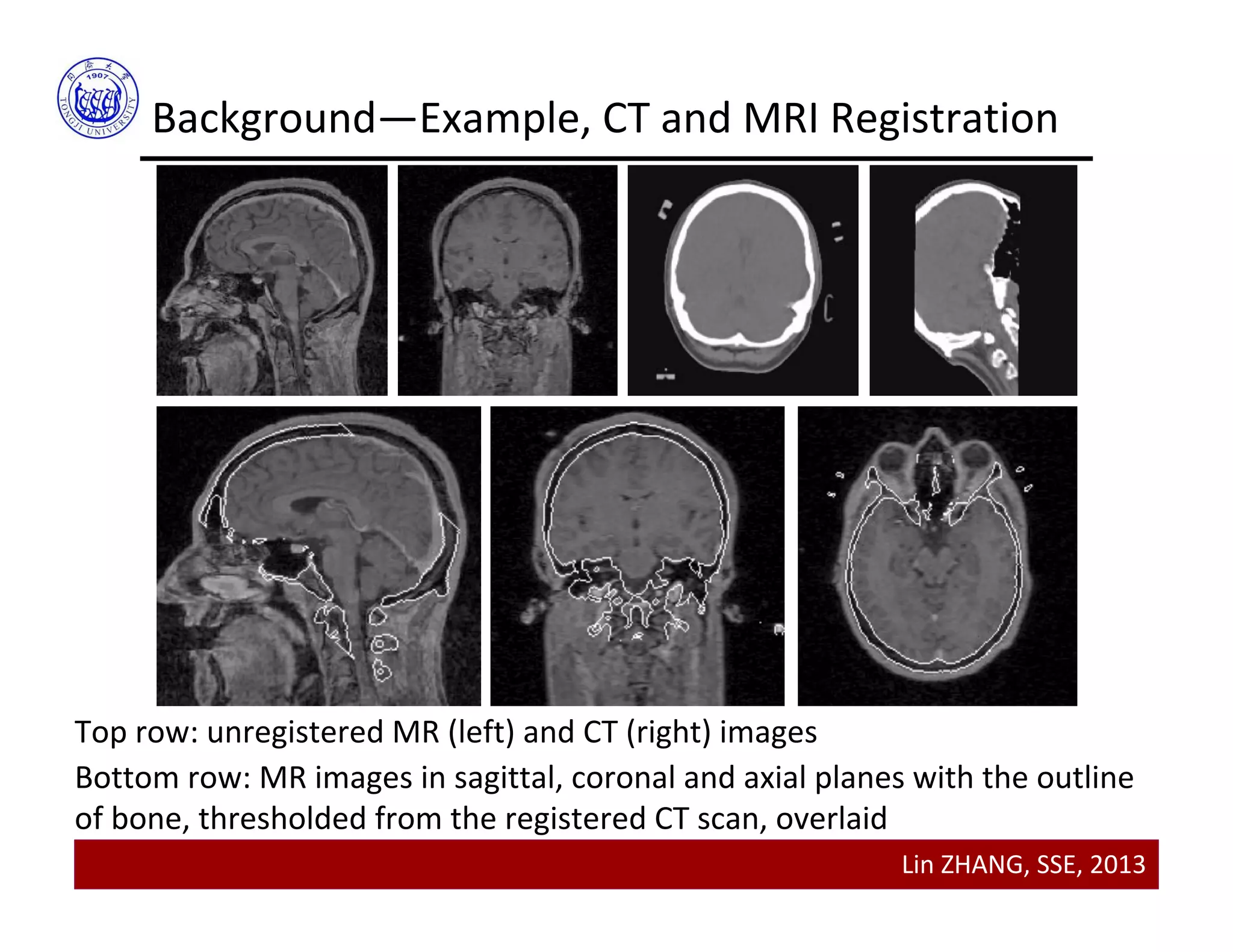 Lin ZHANG, SSE, 2013
Background—Example, CT and MRI Registration
Top row: unregistered MR (left) and CT (right) images 
Bottom row: MR images in sagittal, coronal and axial planes with the outline 
of bone, thresholded from the registered CT scan, overlaid
 