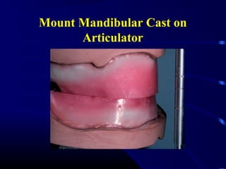 Mount Mandibular Cast on
Articulator
 