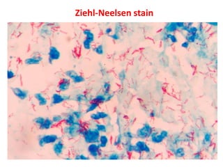 Ziehl-Neelsen stain
 