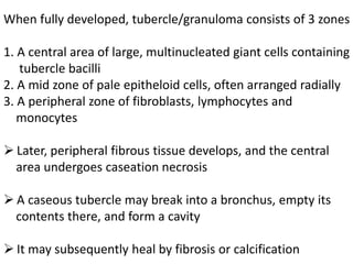 When fully developed, tubercle/granuloma consists of 3 zones
1. A central area of large, multinucleated giant cells containing
tubercle bacilli
2. A mid zone of pale epitheloid cells, often arranged radially
3. A peripheral zone of fibroblasts, lymphocytes and
monocytes
➢ Later, peripheral fibrous tissue develops, and the central
area undergoes caseation necrosis
➢ A caseous tubercle may break into a bronchus, empty its
contents there, and form a cavity
➢ It may subsequently heal by fibrosis or calcification
 