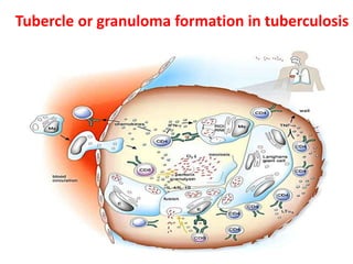 Tubercle or granuloma formation in tuberculosis
 