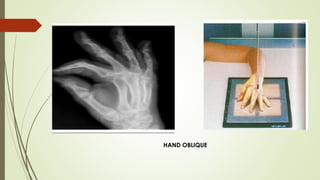 radiographic techniqes 1 upeer limb projection | PDF