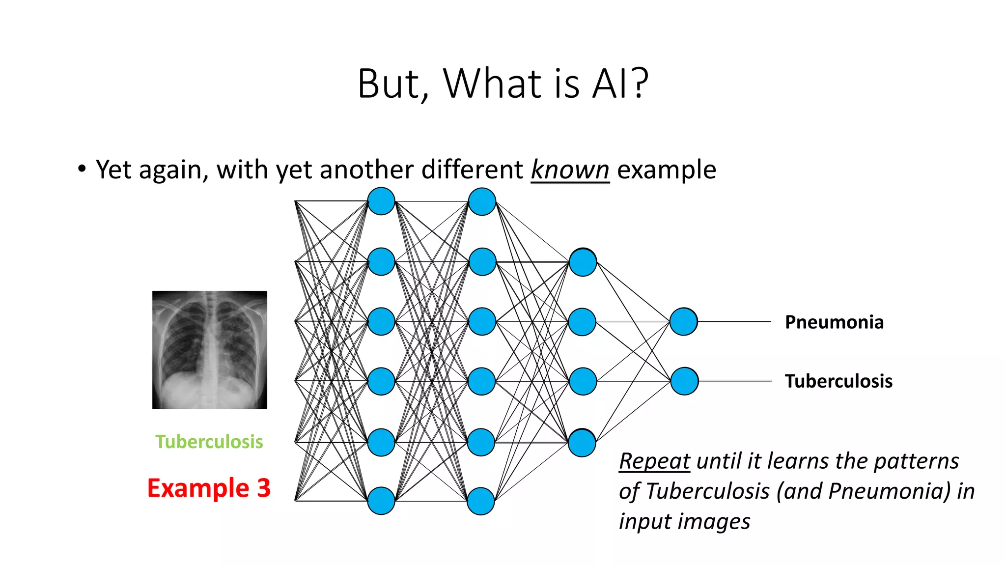 But, What is AI?
Tuberculosis
Pneumonia
Tuberculosis
Example 3
• Yet again, with yet another different known example
Repeat until it learns the patterns
of Tuberculosis (and Pneumonia) in
input images
 