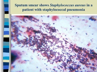 Sputum smear shows Staphylococcus aureus in a
patient with staphylococcal pneumonia

 