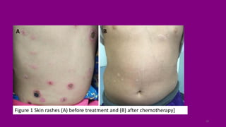 Pediatric Non Hodgkin lymphoma NEW.pdf