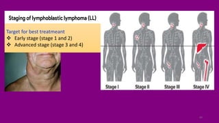 Pediatric Non Hodgkin lymphoma NEW.pdf