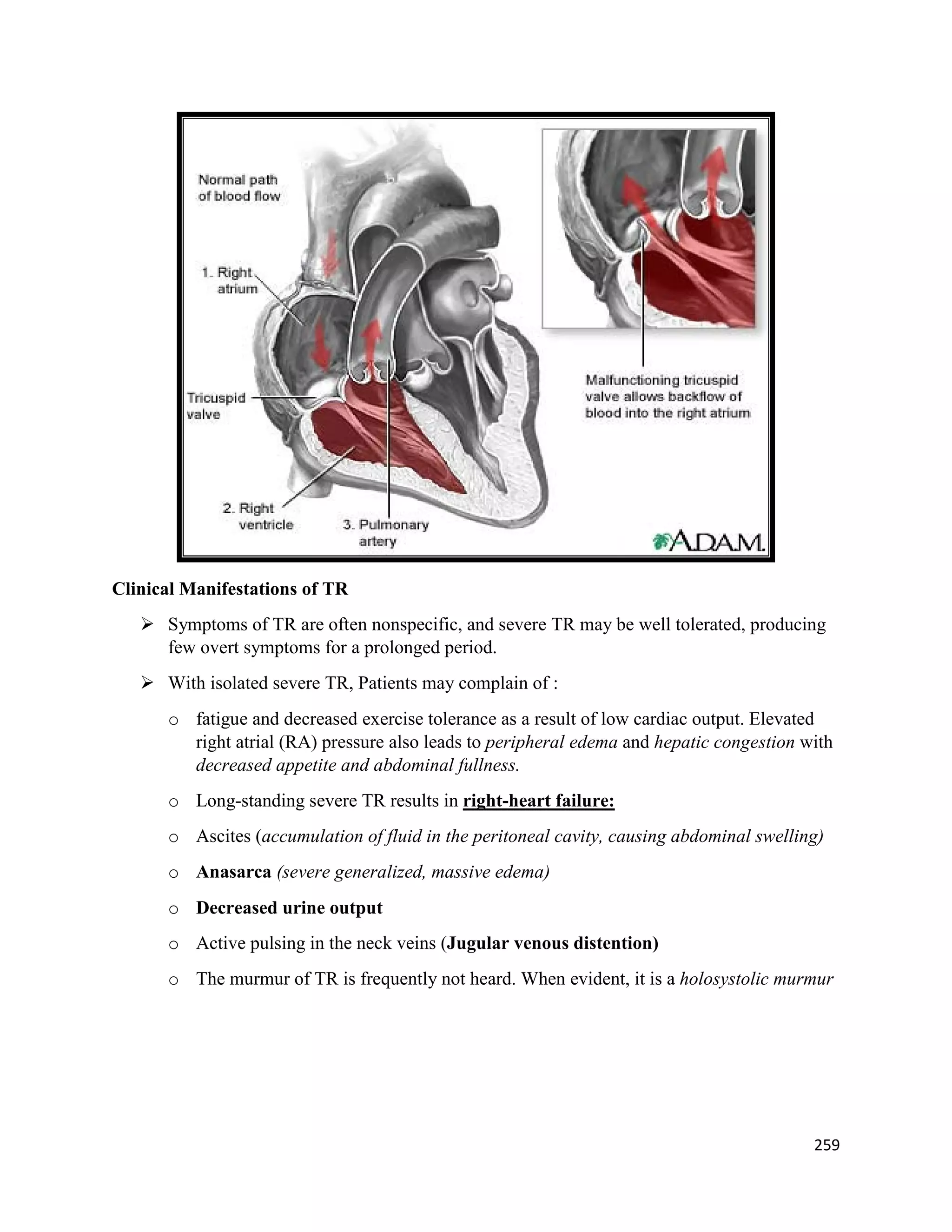Clinical Manifestations of TR
 Symptoms of TR are often nonspecific, and severe TR may be well tolerated, producing
few overt symptoms for a prolonged period.
 With isolated severe TR, Patients may complain of :
o fatigue and decreased exercise tolerance as a result of low cardiac output. Elevated
right atrial (RA) pressure also leads to peripheral edema and hepatic congestion with
decreased appetite and abdominal fullness.
o Long-standing severe TR results in right-heart failure:
o Ascites (accumulation of fluid in the peritoneal cavity, causing abdominal swelling)
o Anasarca (severe generalized, massive edema)
o Decreased urine output
o Active pulsing in the neck veins (Jugular venous distention)
o The murmur of TR is frequently not heard. When evident, it is a holosystolic murmur
259
 
