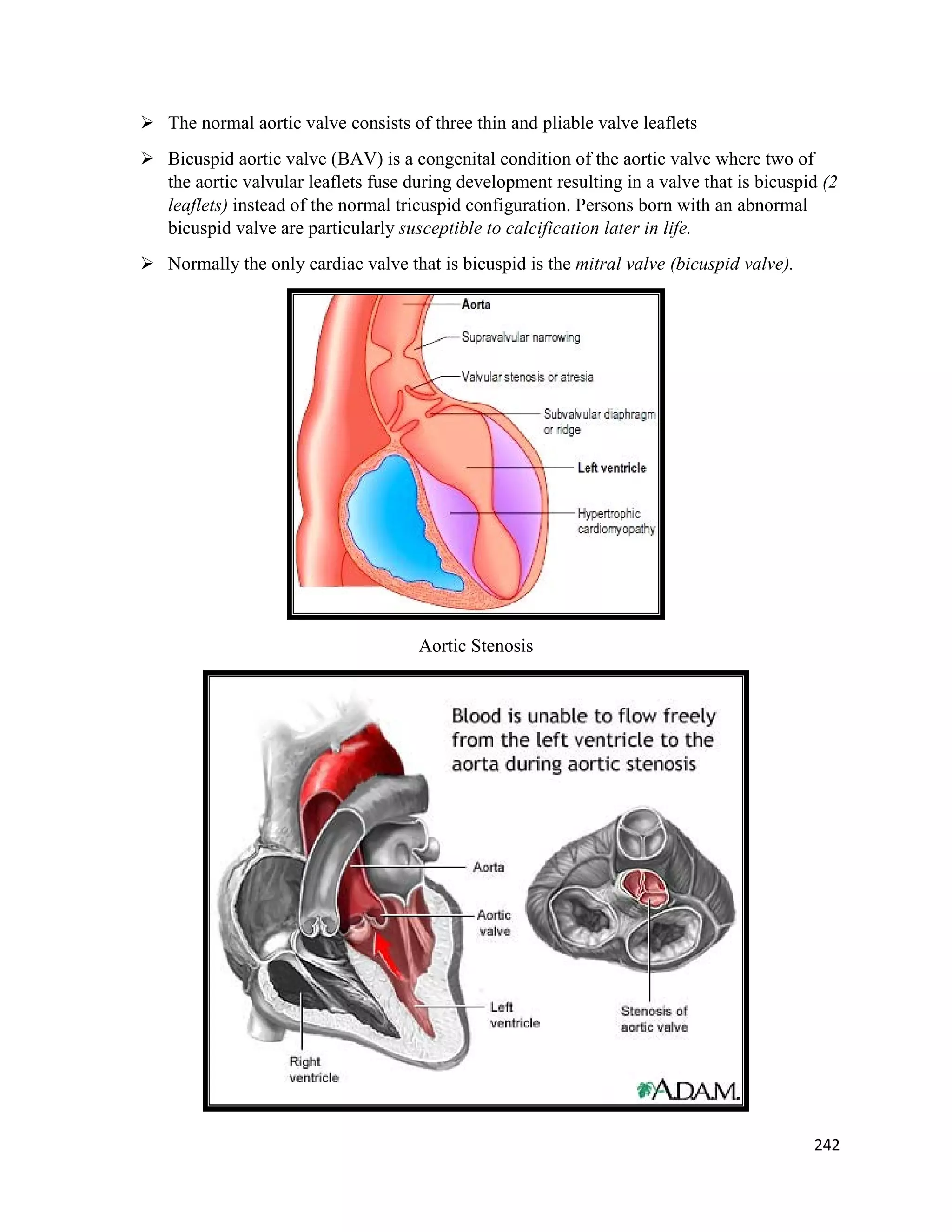  The normal aortic valve consists of three thin and pliable valve leaflets
 Bicuspid aortic valve (BAV) is a congenital condition of the aortic valve where two of
the aortic valvular leaflets fuse during development resulting in a valve that is bicuspid (2
leaflets) instead of the normal tricuspid configuration. Persons born with an abnormal
bicuspid valve are particularly susceptible to calcification later in life.
 Normally the only cardiac valve that is bicuspid is the mitral valve (bicuspid valve).
Aortic Stenosis
242
 