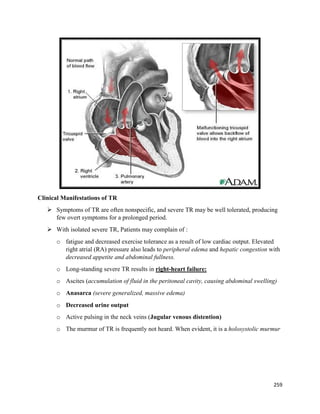 Clinical Manifestations of TR
 Symptoms of TR are often nonspecific, and severe TR may be well tolerated, producing
few overt symptoms for a prolonged period.
 With isolated severe TR, Patients may complain of :
o fatigue and decreased exercise tolerance as a result of low cardiac output. Elevated
right atrial (RA) pressure also leads to peripheral edema and hepatic congestion with
decreased appetite and abdominal fullness.
o Long-standing severe TR results in right-heart failure:
o Ascites (accumulation of fluid in the peritoneal cavity, causing abdominal swelling)
o Anasarca (severe generalized, massive edema)
o Decreased urine output
o Active pulsing in the neck veins (Jugular venous distention)
o The murmur of TR is frequently not heard. When evident, it is a holosystolic murmur
259
 