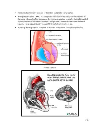  The normal aortic valve consists of three thin and pliable valve leaflets
 Bicuspid aortic valve (BAV) is a congenital condition of the aortic valve where two of
the aortic valvular leaflets fuse during development resulting in a valve that is bicuspid (2
leaflets) instead of the normal tricuspid configuration. Persons born with an abnormal
bicuspid valve are particularly susceptible to calcification later in life.
 Normally the only cardiac valve that is bicuspid is the mitral valve (bicuspid valve).
Aortic Stenosis
242
 