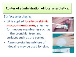 Routes of administration of local anesthetics:
Surface anesthesia:
• LA is applied locally on skin &
mucous membranes, effective
for mucous membranes such as
in the bronchial tree, and
surfaces such as the cornea.
• A non-crystalline mixture of
lidocaine may be used for skin.
 