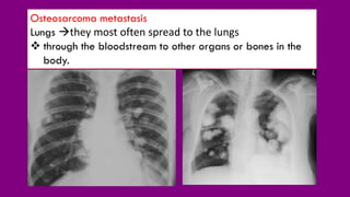Osteosarcoma metastasis
Lungs they most often spread to the lungs
 through the bloodstream to other organs or bones in the
body.
 