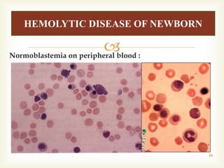 Hemolytic Disease of newborn .. In which Hemolysis if RBC Occurs | PPTX