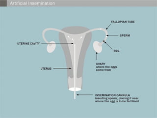 Infertility Overview Comprehensive Overview of Infertility: Causes, Diagnosis, and Advanced ...