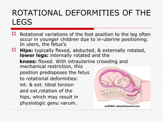Comprehensive Overview of Lower Limb Birth Deformations and Their ...
