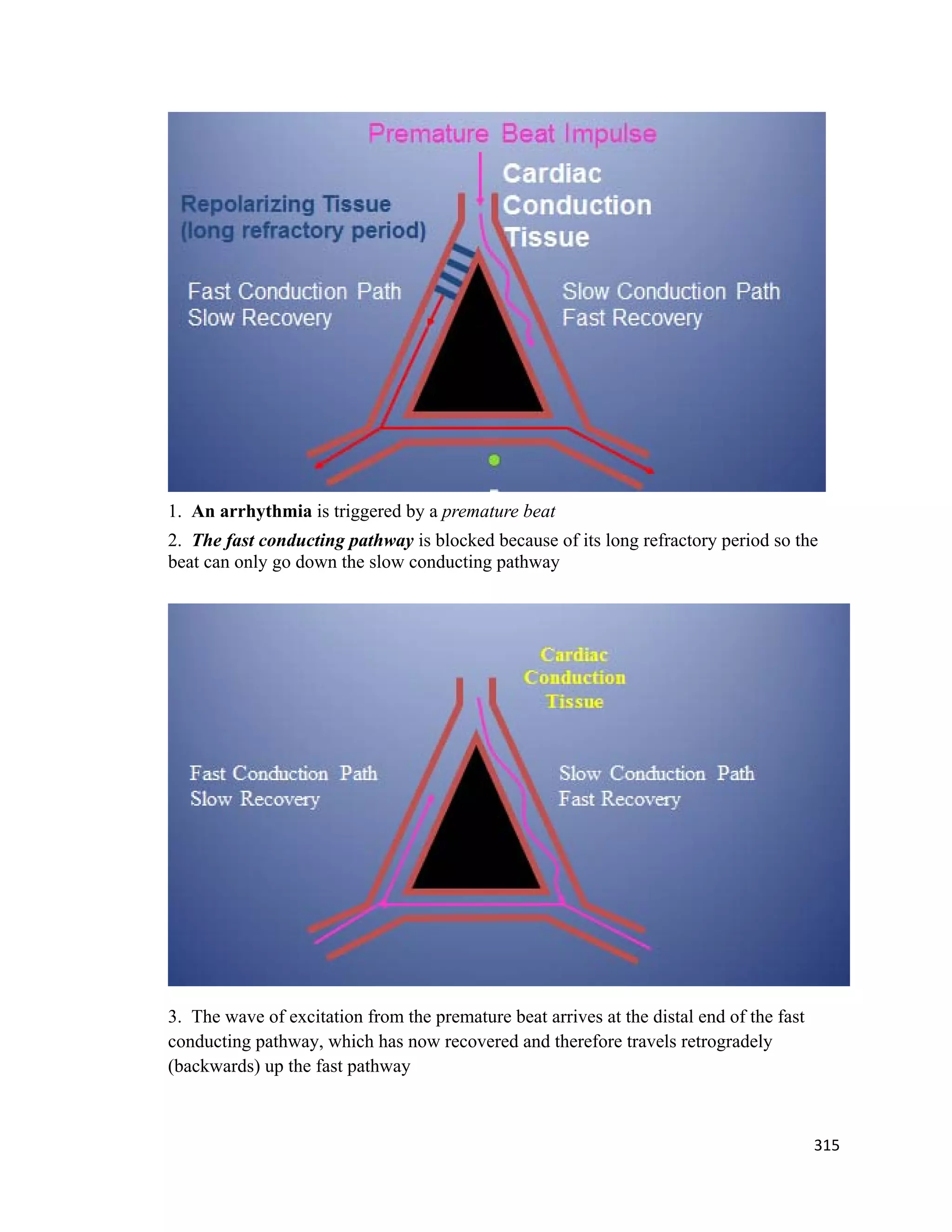 315 
 
1. An arrhythmia is triggered by a premature beat
2. The fast conducting pathway is blocked because of its long refractory period so the
beat can only go down the slow conducting pathway
3. The wave of excitation from the premature beat arrives at the distal end of the fast
conducting pathway, which has now recovered and therefore travels retrogradely
(backwards) up the fast pathway
 