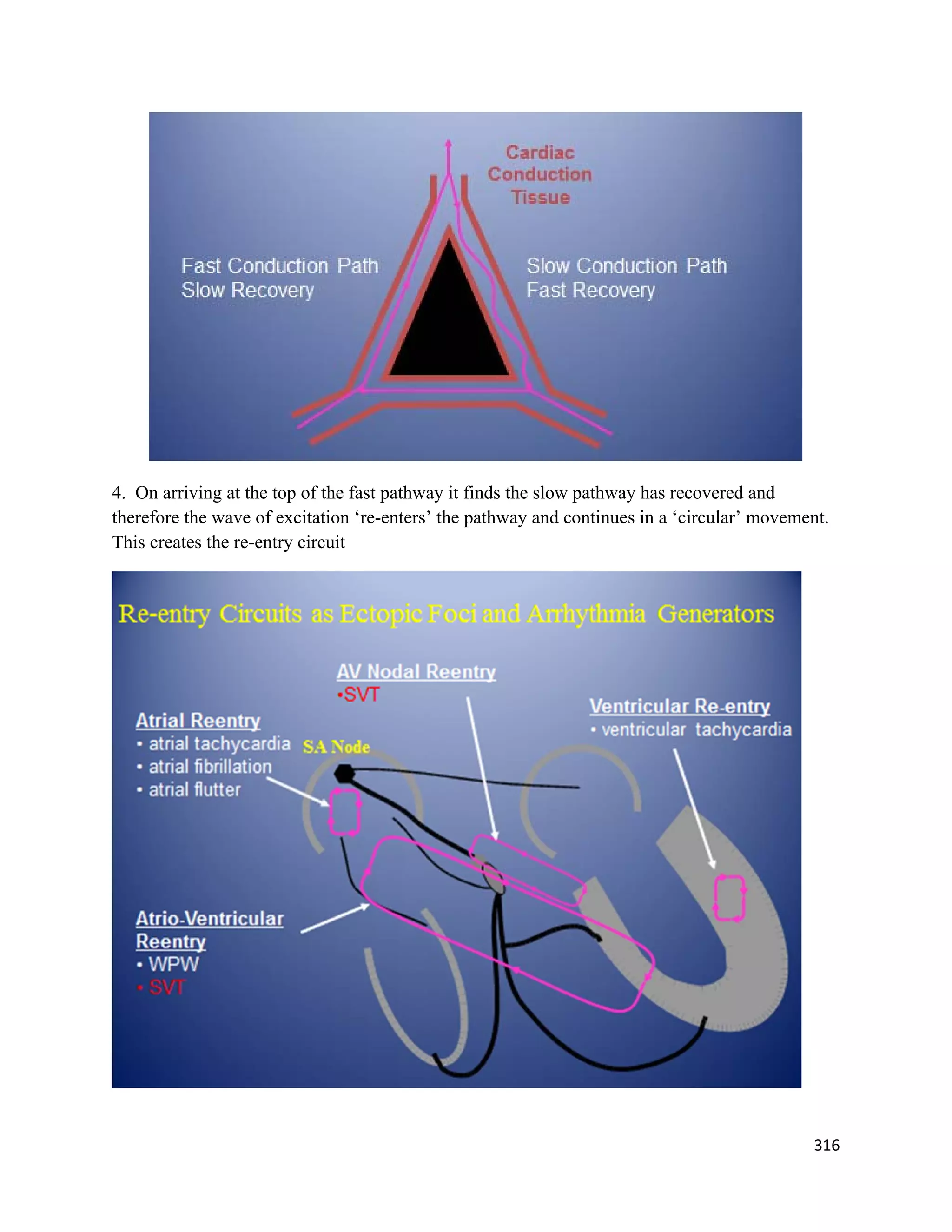316 
 
4. On arriving at the top of the fast pathway it finds the slow pathway has recovered and
therefore the wave of excitation ‘re-enters’ the pathway and continues in a ‘circular’ movement.
This creates the re-entry circuit
 
