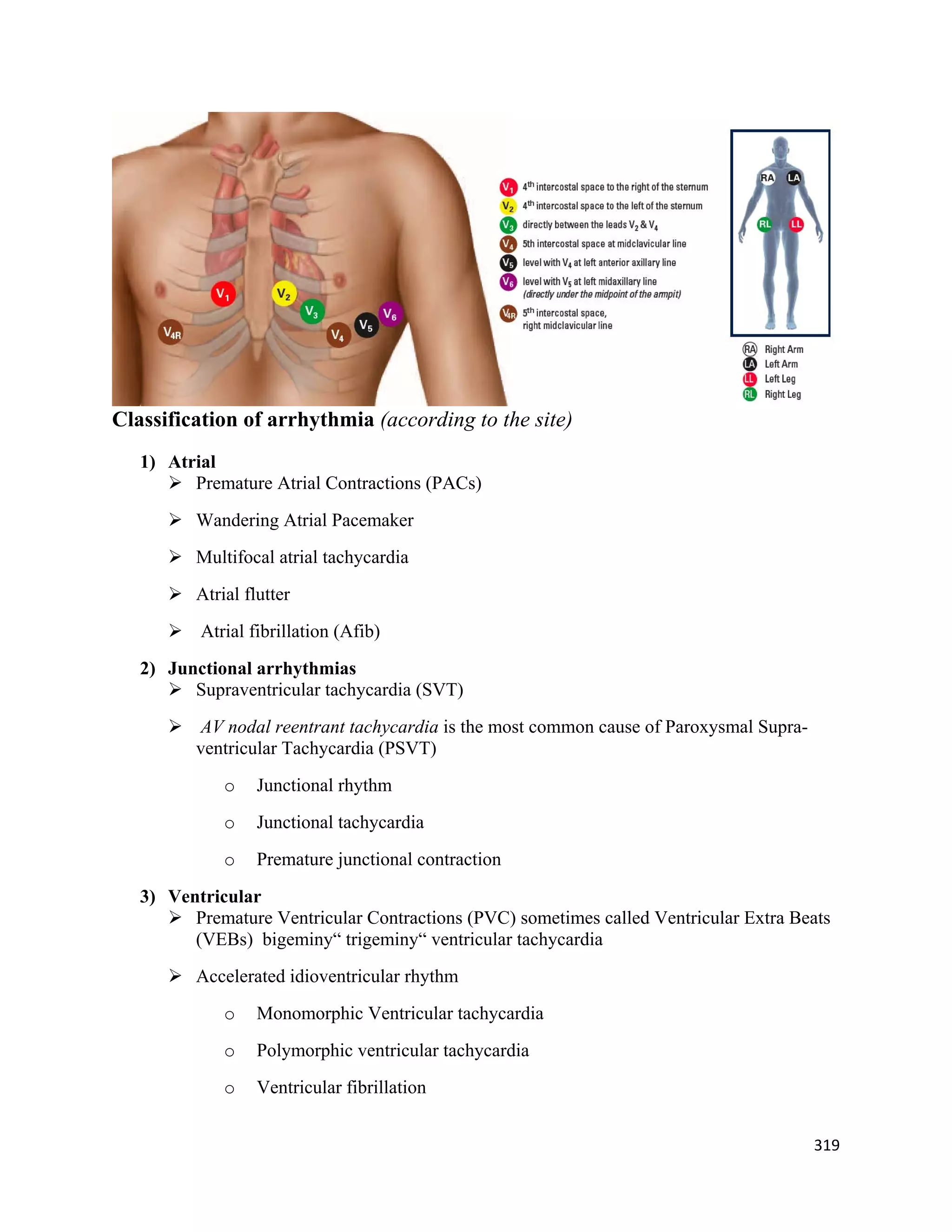 319 
 
Classification of arrhythmia (according to the site)
1) Atrial
 Premature Atrial Contractions (PACs)
 Wandering Atrial Pacemaker
 Multifocal atrial tachycardia
 Atrial flutter
 Atrial fibrillation (Afib)
2) Junctional arrhythmias
 Supraventricular tachycardia (SVT)
 AV nodal reentrant tachycardia is the most common cause of Paroxysmal Supra-
ventricular Tachycardia (PSVT)
o Junctional rhythm
o Junctional tachycardia
o Premature junctional contraction
3) Ventricular
 Premature Ventricular Contractions (PVC) sometimes called Ventricular Extra Beats
(VEBs) bigeminy“ trigeminy“ ventricular tachycardia
 Accelerated idioventricular rhythm
o Monomorphic Ventricular tachycardia
o Polymorphic ventricular tachycardia
o Ventricular fibrillation
 