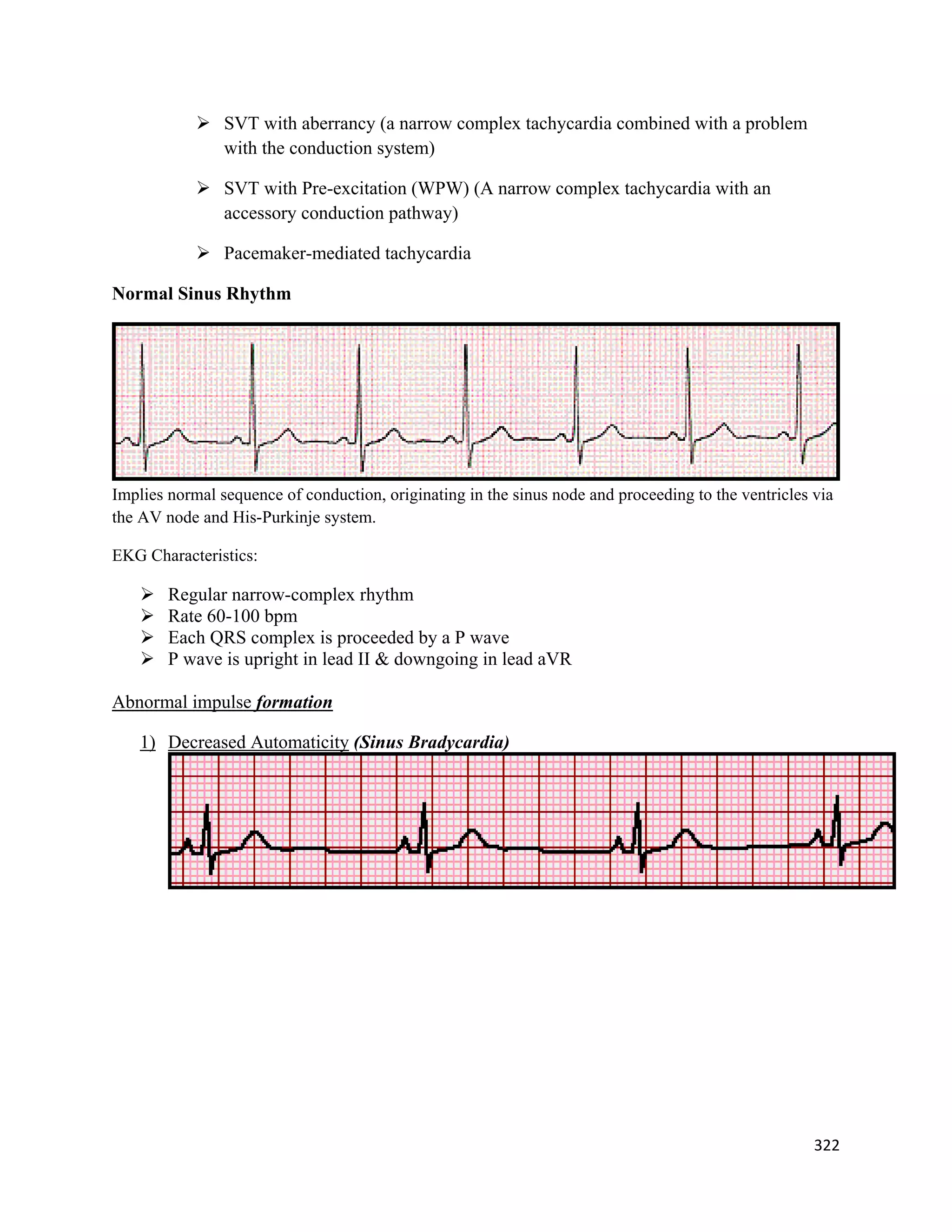322 
 
 SVT with aberrancy (a narrow complex tachycardia combined with a problem
with the conduction system)
 SVT with Pre-excitation (WPW) (A narrow complex tachycardia with an
accessory conduction pathway)
 Pacemaker-mediated tachycardia
Normal Sinus Rhythm
Implies normal sequence of conduction, originating in the sinus node and proceeding to the ventricles via
the AV node and His-Purkinje system.
EKG Characteristics:
 Regular narrow-complex rhythm
 Rate 60-100 bpm
 Each QRS complex is proceeded by a P wave
 P wave is upright in lead II & downgoing in lead aVR
Abnormal impulse formation
1) Decreased Automaticity (Sinus Bradycardia)
 