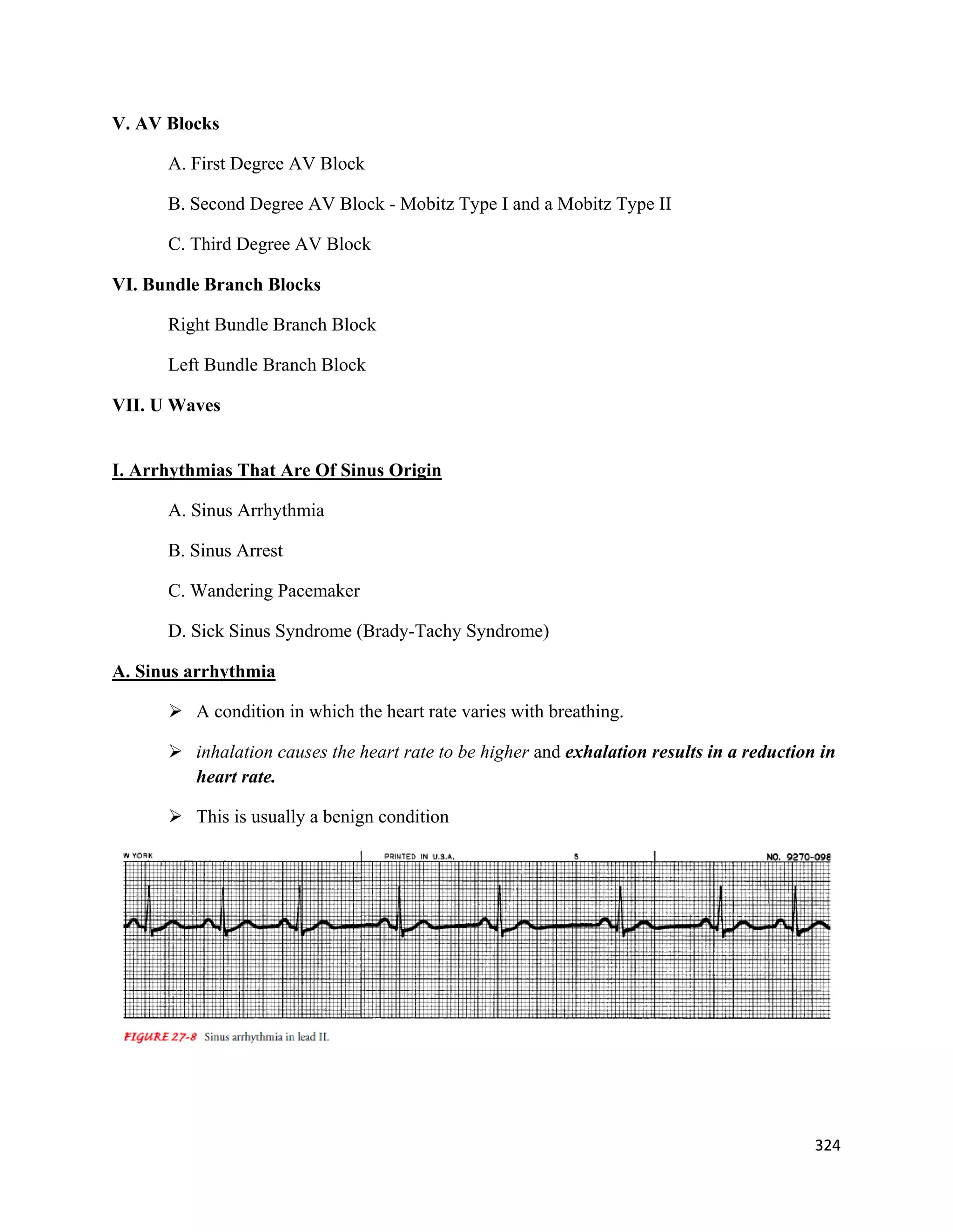 324 
 
V. AV Blocks
A. First Degree AV Block
B. Second Degree AV Block - Mobitz Type I and a Mobitz Type II
C. Third Degree AV Block
VI. Bundle Branch Blocks
Right Bundle Branch Block
Left Bundle Branch Block
VII. U Waves
I. Arrhythmias That Are Of Sinus Origin
A. Sinus Arrhythmia
B. Sinus Arrest
C. Wandering Pacemaker
D. Sick Sinus Syndrome (Brady-Tachy Syndrome)
A. Sinus arrhythmia
 A condition in which the heart rate varies with breathing.
 inhalation causes the heart rate to be higher and exhalation results in a reduction in
heart rate.
 This is usually a benign condition
 