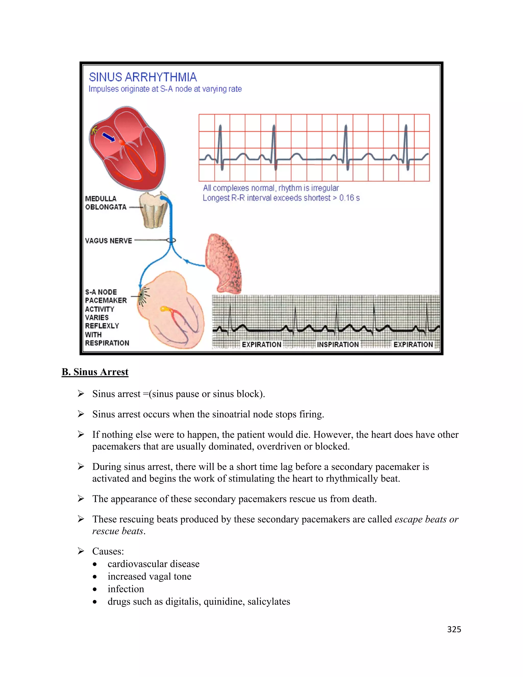 325 
 
B. Sinus Arrest
 Sinus arrest =(sinus pause or sinus block).
 Sinus arrest occurs when the sinoatrial node stops firing.
 If nothing else were to happen, the patient would die. However, the heart does have other
pacemakers that are usually dominated, overdriven or blocked.
 During sinus arrest, there will be a short time lag before a secondary pacemaker is
activated and begins the work of stimulating the heart to rhythmically beat.
 The appearance of these secondary pacemakers rescue us from death.
 These rescuing beats produced by these secondary pacemakers are called escape beats or
rescue beats.
 Causes:
 cardiovascular disease
 increased vagal tone
 infection
 drugs such as digitalis, quinidine, salicylates
 