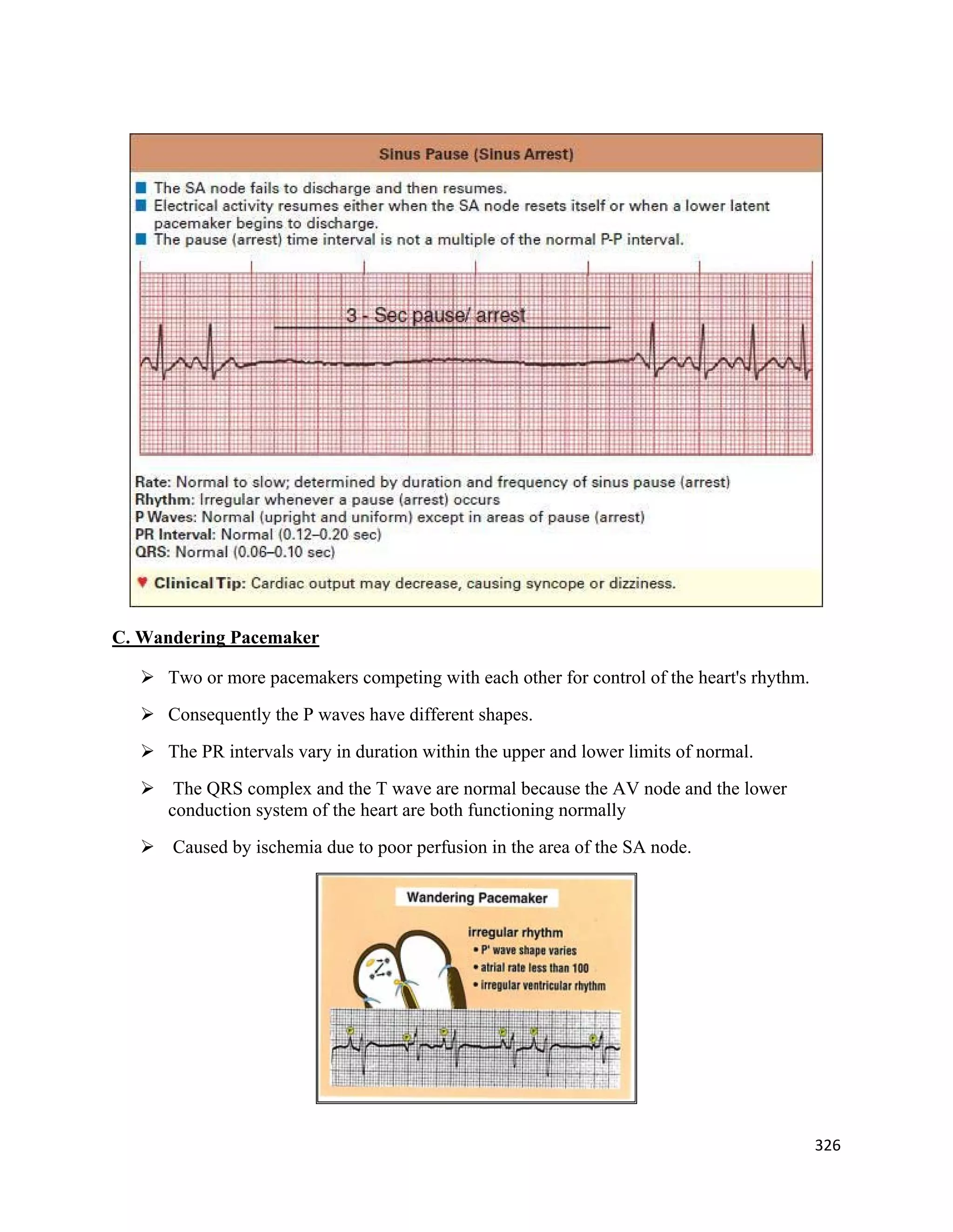 326 
 
C. Wandering Pacemaker
 Two or more pacemakers competing with each other for control of the heart's rhythm.
 Consequently the P waves have different shapes.
 The PR intervals vary in duration within the upper and lower limits of normal.
 The QRS complex and the T wave are normal because the AV node and the lower
conduction system of the heart are both functioning normally
 Caused by ischemia due to poor perfusion in the area of the SA node.
 