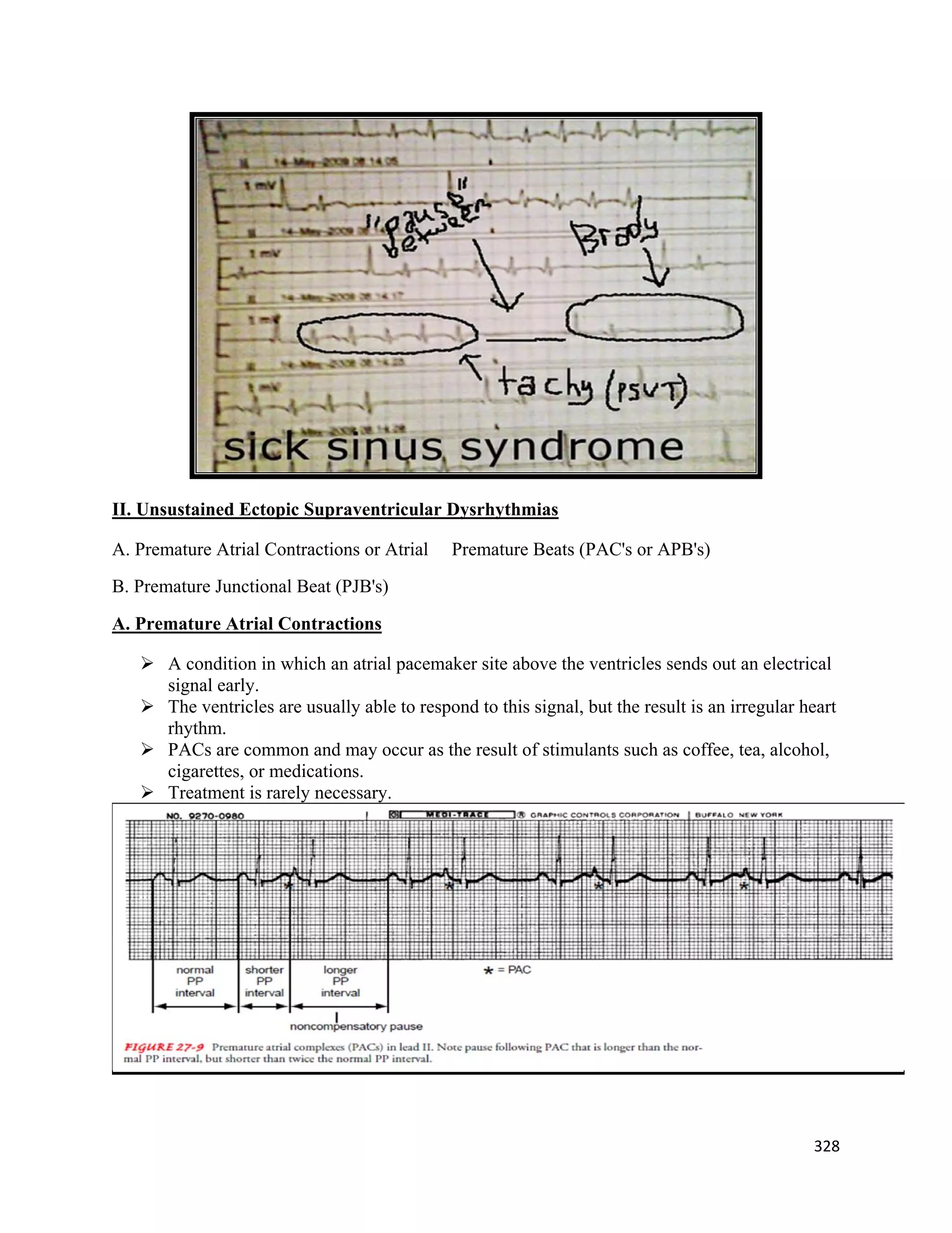 328 
 
II. Unsustained Ectopic Supraventricular Dysrhythmias
A. Premature Atrial Contractions or Atrial Premature Beats (PAC's or APB's)
B. Premature Junctional Beat (PJB's)
A. Premature Atrial Contractions
 A condition in which an atrial pacemaker site above the ventricles sends out an electrical
signal early.
 The ventricles are usually able to respond to this signal, but the result is an irregular heart
rhythm.
 PACs are common and may occur as the result of stimulants such as coffee, tea, alcohol,
cigarettes, or medications.
 Treatment is rarely necessary.
 