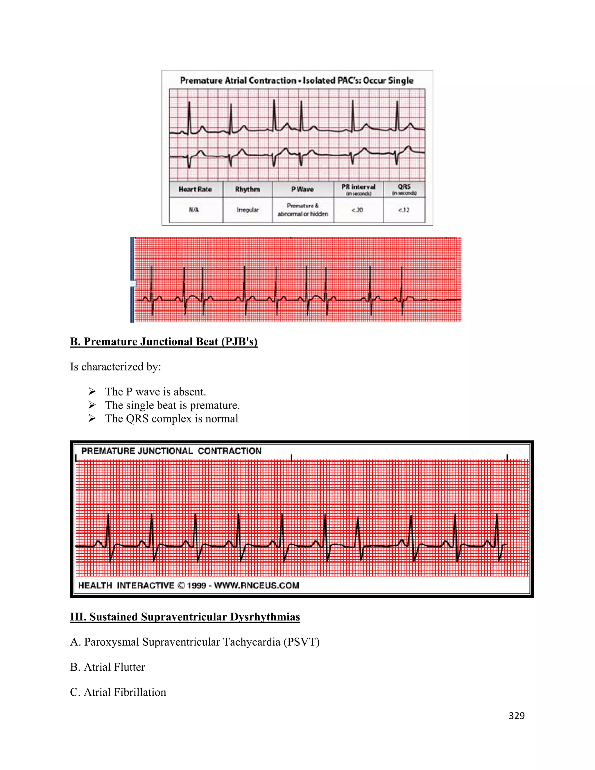 329 
 
B. Premature Junctional Beat (PJB's)
Is characterized by:
 The P wave is absent.
 The single beat is premature.
 The QRS complex is normal
III. Sustained Supraventricular Dysrhythmias
A. Paroxysmal Supraventricular Tachycardia (PSVT)
B. Atrial Flutter
C. Atrial Fibrillation
 