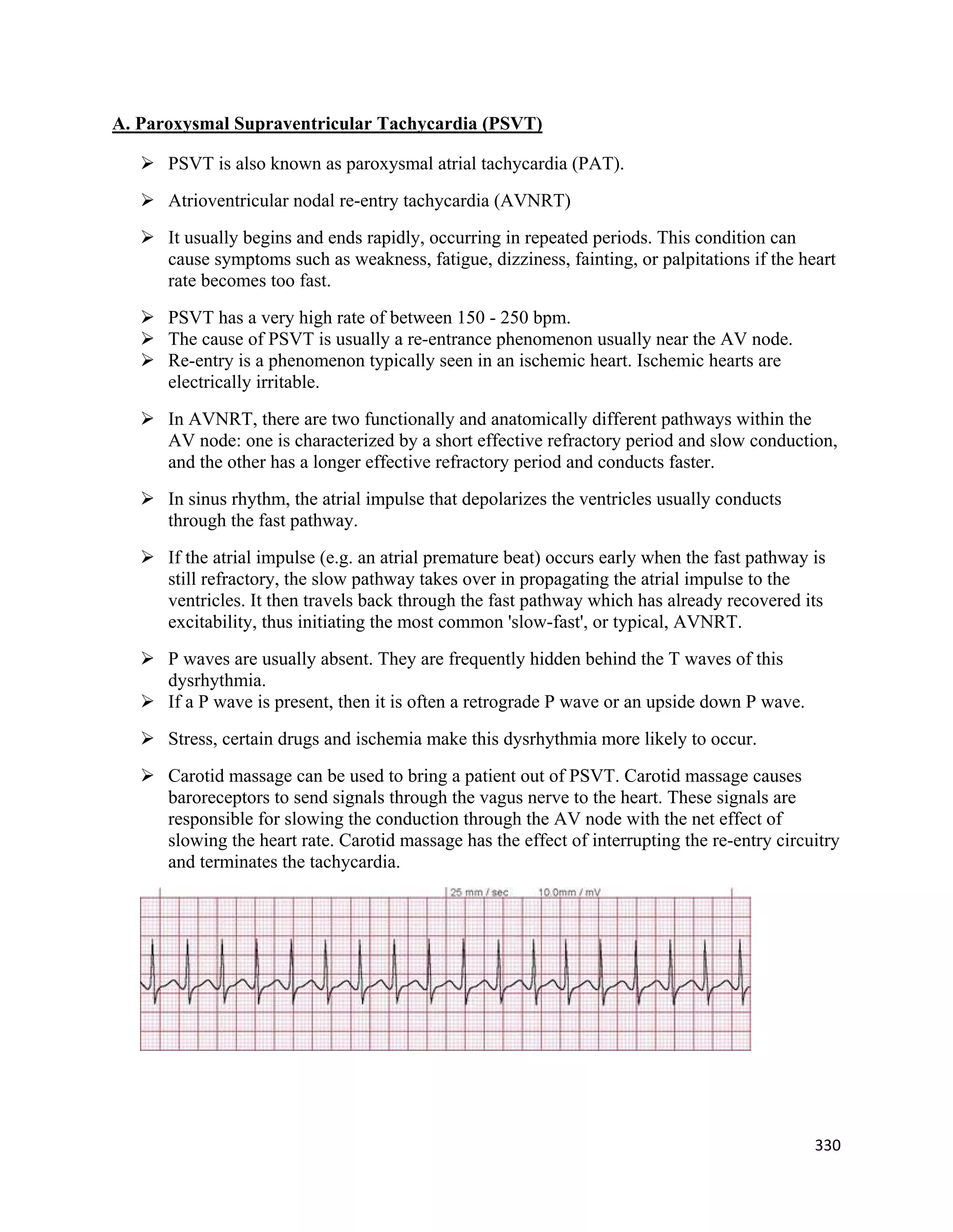 330 
 
A. Paroxysmal Supraventricular Tachycardia (PSVT)
 PSVT is also known as paroxysmal atrial tachycardia (PAT).
 Atrioventricular nodal re-entry tachycardia (AVNRT)
 It usually begins and ends rapidly, occurring in repeated periods. This condition can
cause symptoms such as weakness, fatigue, dizziness, fainting, or palpitations if the heart
rate becomes too fast.
 PSVT has a very high rate of between 150 - 250 bpm.
 The cause of PSVT is usually a re-entrance phenomenon usually near the AV node.
 Re-entry is a phenomenon typically seen in an ischemic heart. Ischemic hearts are
electrically irritable.
 In AVNRT, there are two functionally and anatomically different pathways within the
AV node: one is characterized by a short effective refractory period and slow conduction,
and the other has a longer effective refractory period and conducts faster.
 In sinus rhythm, the atrial impulse that depolarizes the ventricles usually conducts
through the fast pathway.
 If the atrial impulse (e.g. an atrial premature beat) occurs early when the fast pathway is
still refractory, the slow pathway takes over in propagating the atrial impulse to the
ventricles. It then travels back through the fast pathway which has already recovered its
excitability, thus initiating the most common 'slow-fast', or typical, AVNRT.
 P waves are usually absent. They are frequently hidden behind the T waves of this
dysrhythmia.
 If a P wave is present, then it is often a retrograde P wave or an upside down P wave.
 Stress, certain drugs and ischemia make this dysrhythmia more likely to occur.
 Carotid massage can be used to bring a patient out of PSVT. Carotid massage causes
baroreceptors to send signals through the vagus nerve to the heart. These signals are
responsible for slowing the conduction through the AV node with the net effect of
slowing the heart rate. Carotid massage has the effect of interrupting the re-entry circuitry
and terminates the tachycardia.
 