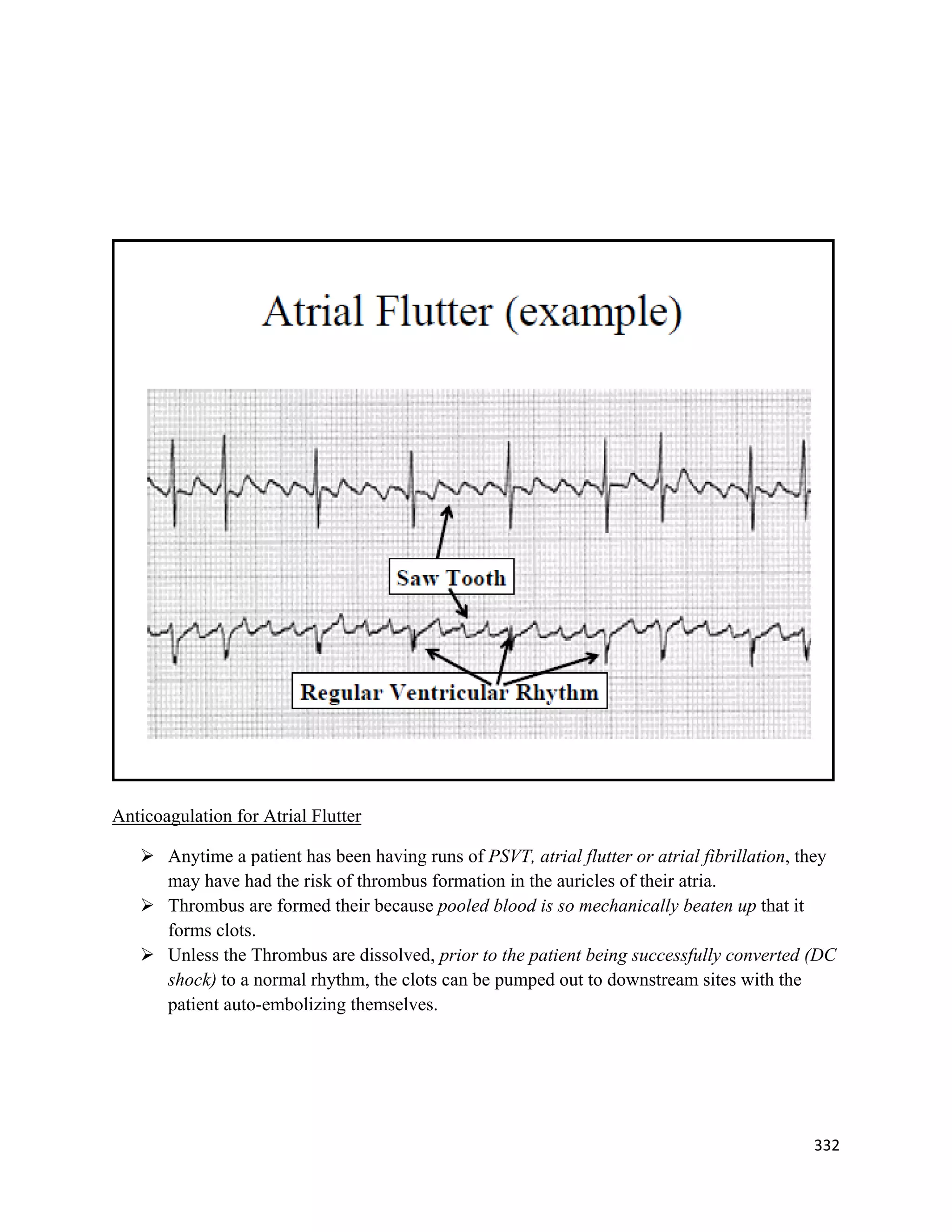 332 
 
Anticoagulation for Atrial Flutter
 Anytime a patient has been having runs of PSVT, atrial flutter or atrial fibrillation, they
may have had the risk of thrombus formation in the auricles of their atria.
 Thrombus are formed their because pooled blood is so mechanically beaten up that it
forms clots.
 Unless the Thrombus are dissolved, prior to the patient being successfully converted (DC
shock) to a normal rhythm, the clots can be pumped out to downstream sites with the
patient auto-embolizing themselves.
 