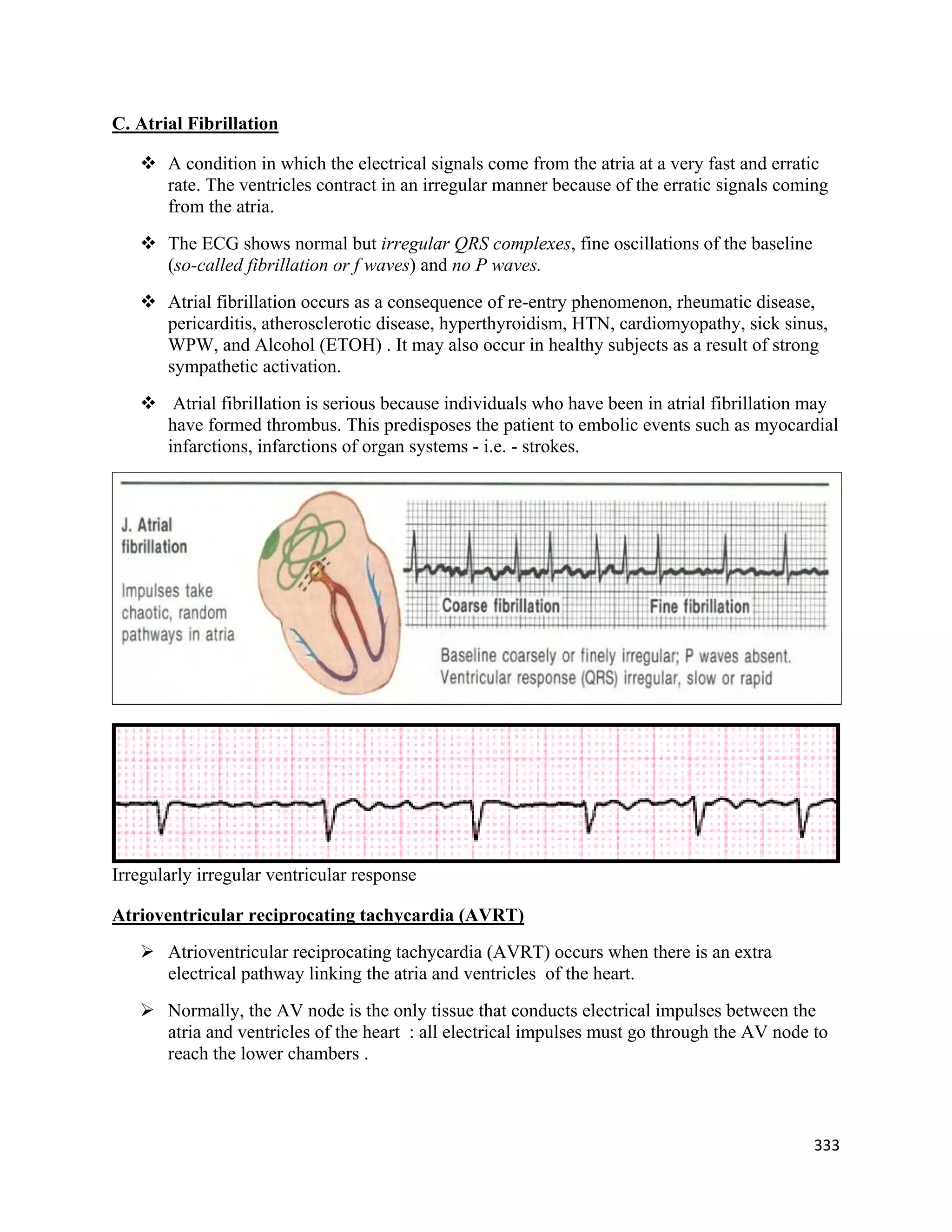 333 
 
C. Atrial Fibrillation
 A condition in which the electrical signals come from the atria at a very fast and erratic
rate. The ventricles contract in an irregular manner because of the erratic signals coming
from the atria.
 The ECG shows normal but irregular QRS complexes, fine oscillations of the baseline
(so-called fibrillation or f waves) and no P waves.
 Atrial fibrillation occurs as a consequence of re-entry phenomenon, rheumatic disease,
pericarditis, atherosclerotic disease, hyperthyroidism, HTN, cardiomyopathy, sick sinus,
WPW, and Alcohol (ETOH) . It may also occur in healthy subjects as a result of strong
sympathetic activation.
 Atrial fibrillation is serious because individuals who have been in atrial fibrillation may
have formed thrombus. This predisposes the patient to embolic events such as myocardial
infarctions, infarctions of organ systems - i.e. - strokes.
Irregularly irregular ventricular response
Atrioventricular reciprocating tachycardia (AVRT)
 Atrioventricular reciprocating tachycardia (AVRT) occurs when there is an extra
electrical pathway linking the atria and ventricles of the heart.
 Normally, the AV node is the only tissue that conducts electrical impulses between the
atria and ventricles of the heart : all electrical impulses must go through the AV node to
reach the lower chambers .
 