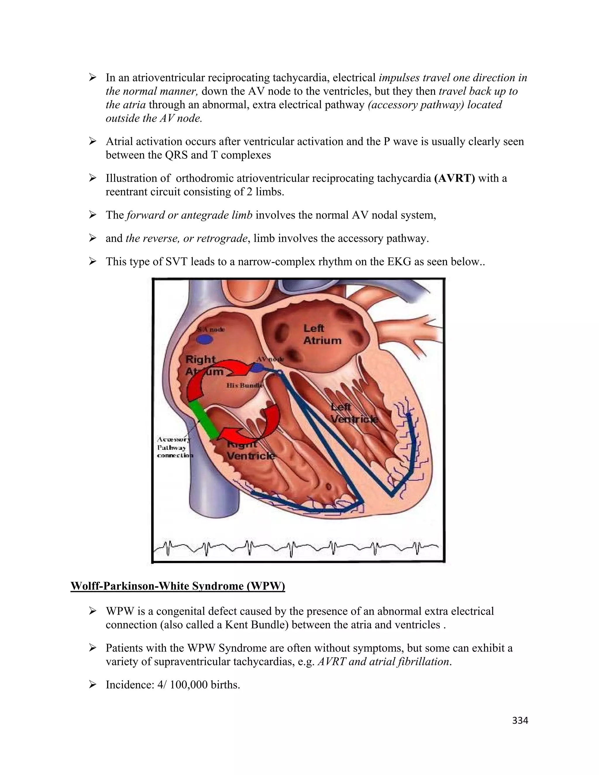 334 
 
 In an atrioventricular reciprocating tachycardia, electrical impulses travel one direction in
the normal manner, down the AV node to the ventricles, but they then travel back up to
the atria through an abnormal, extra electrical pathway (accessory pathway) located
outside the AV node.
 Atrial activation occurs after ventricular activation and the P wave is usually clearly seen
between the QRS and T complexes
 Illustration of orthodromic atrioventricular reciprocating tachycardia (AVRT) with a
reentrant circuit consisting of 2 limbs.
 The forward or antegrade limb involves the normal AV nodal system,
 and the reverse, or retrograde, limb involves the accessory pathway.
 This type of SVT leads to a narrow-complex rhythm on the EKG as seen below..
Wolff-Parkinson-White Syndrome (WPW)
 WPW is a congenital defect caused by the presence of an abnormal extra electrical
connection (also called a Kent Bundle) between the atria and ventricles .
 Patients with the WPW Syndrome are often without symptoms, but some can exhibit a
variety of supraventricular tachycardias, e.g. AVRT and atrial fibrillation.
 Incidence: 4/ 100,000 births.
 