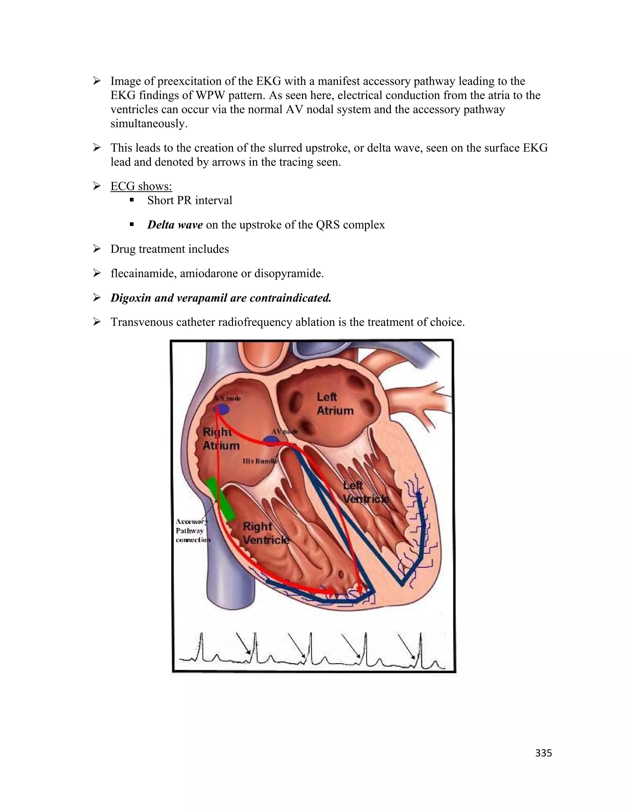 335 
 
 Image of preexcitation of the EKG with a manifest accessory pathway leading to the
EKG findings of WPW pattern. As seen here, electrical conduction from the atria to the
ventricles can occur via the normal AV nodal system and the accessory pathway
simultaneously.
 This leads to the creation of the slurred upstroke, or delta wave, seen on the surface EKG
lead and denoted by arrows in the tracing seen.
 ECG shows:
 Short PR interval
 Delta wave on the upstroke of the QRS complex
 Drug treatment includes
 flecainamide, amiodarone or disopyramide.
 Digoxin and verapamil are contraindicated.
 Transvenous catheter radiofrequency ablation is the treatment of choice.
 