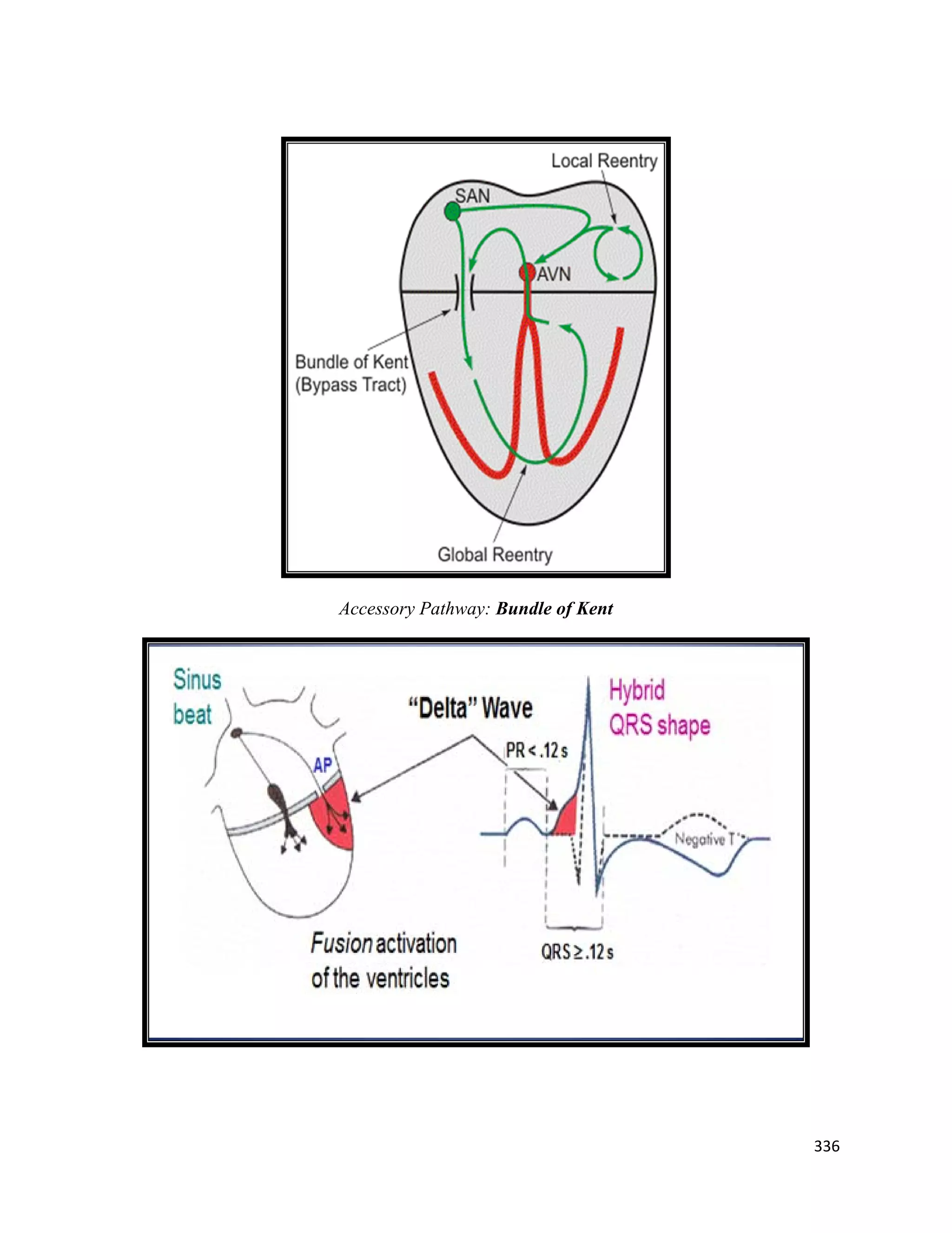 336 
 
Accessory Pathway: Bundle of Kent
 