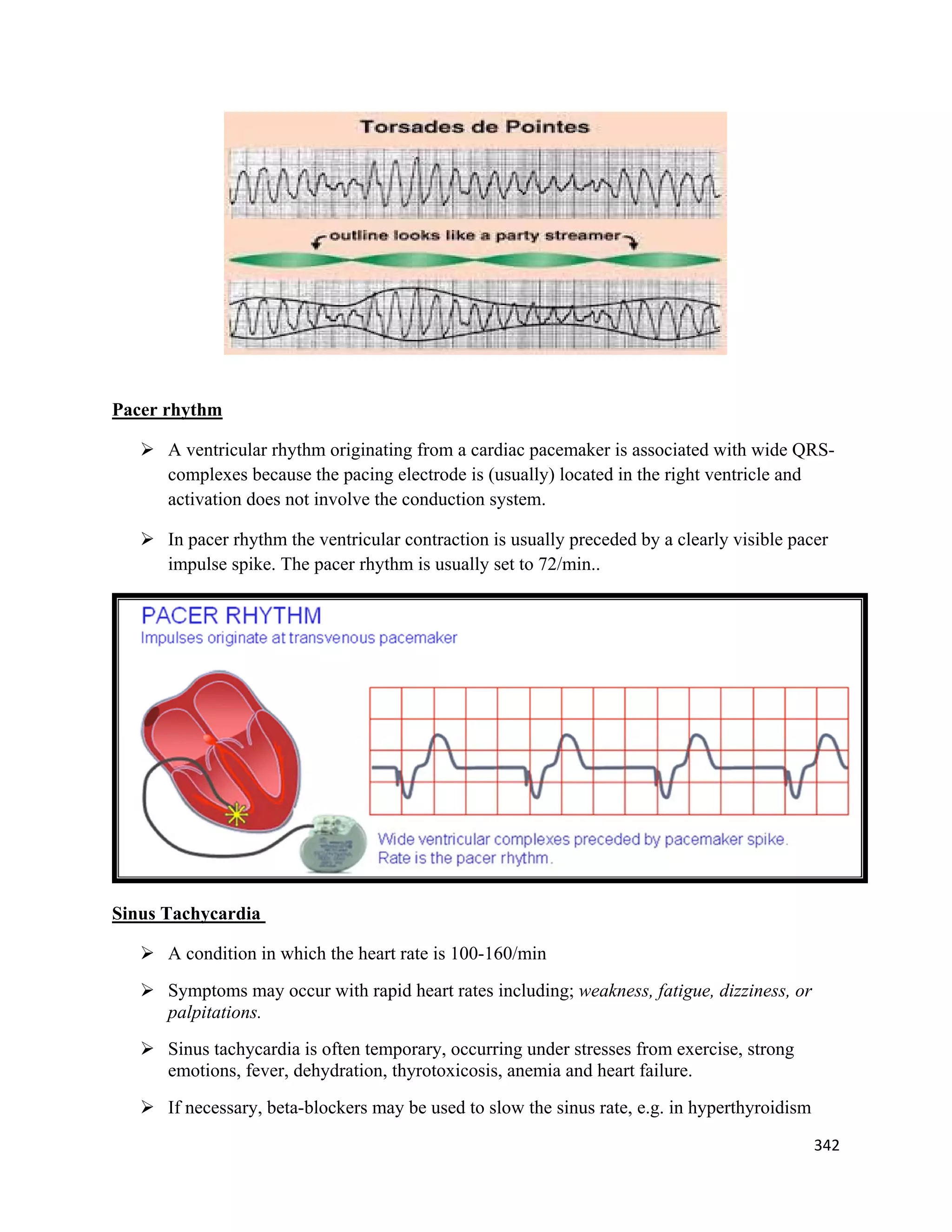342 
 
Pacer rhythm
 A ventricular rhythm originating from a cardiac pacemaker is associated with wide QRS-
complexes because the pacing electrode is (usually) located in the right ventricle and
activation does not involve the conduction system.
 In pacer rhythm the ventricular contraction is usually preceded by a clearly visible pacer
impulse spike. The pacer rhythm is usually set to 72/min..
Sinus Tachycardia
 A condition in which the heart rate is 100-160/min
 Symptoms may occur with rapid heart rates including; weakness, fatigue, dizziness, or
palpitations.
 Sinus tachycardia is often temporary, occurring under stresses from exercise, strong
emotions, fever, dehydration, thyrotoxicosis, anemia and heart failure.
 If necessary, beta-blockers may be used to slow the sinus rate, e.g. in hyperthyroidism
 
