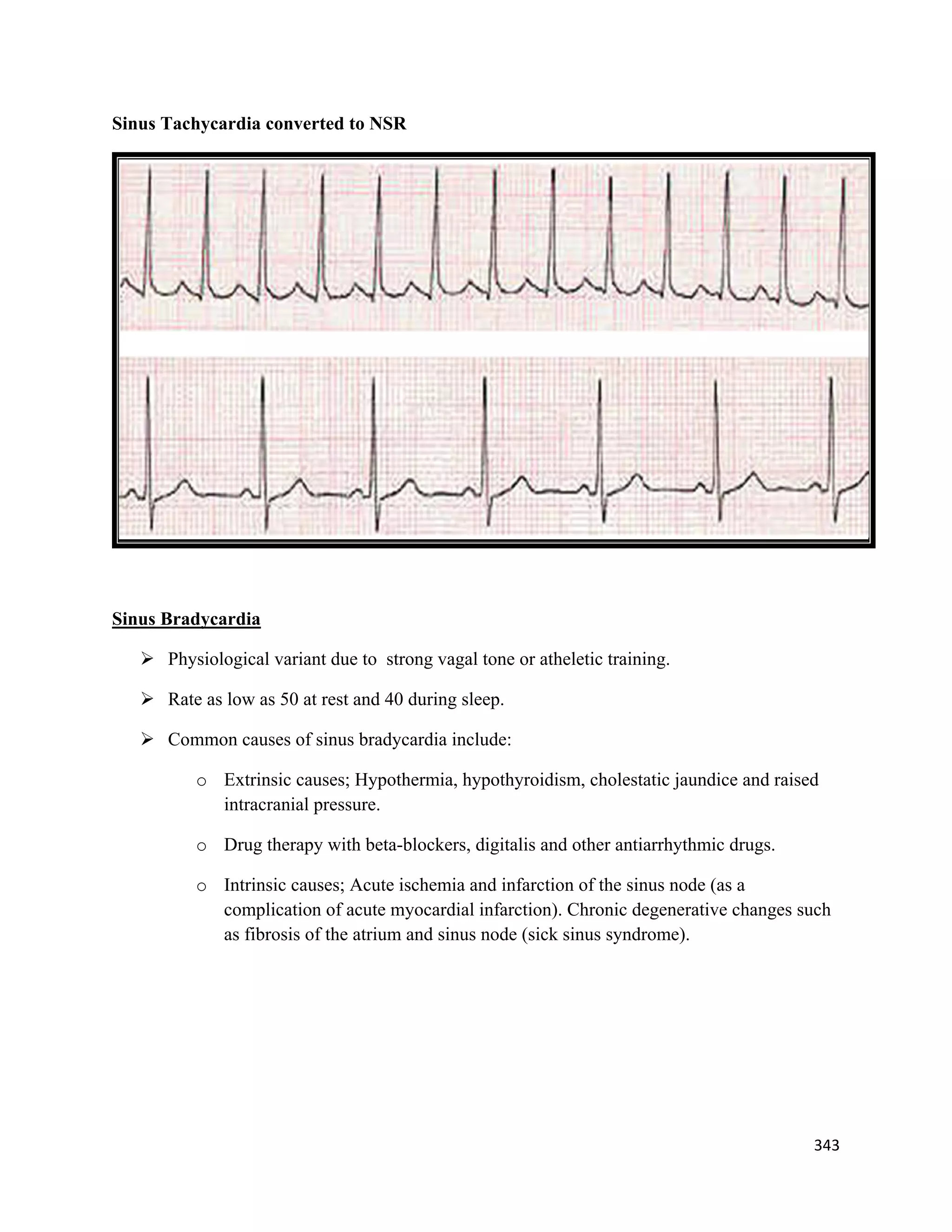 343 
 
Sinus Tachycardia converted to NSR
Sinus Bradycardia
 Physiological variant due to strong vagal tone or atheletic training.
 Rate as low as 50 at rest and 40 during sleep.
 Common causes of sinus bradycardia include:
o Extrinsic causes; Hypothermia, hypothyroidism, cholestatic jaundice and raised
intracranial pressure.
o Drug therapy with beta-blockers, digitalis and other antiarrhythmic drugs.
o Intrinsic causes; Acute ischemia and infarction of the sinus node (as a
complication of acute myocardial infarction). Chronic degenerative changes such
as fibrosis of the atrium and sinus node (sick sinus syndrome).
 