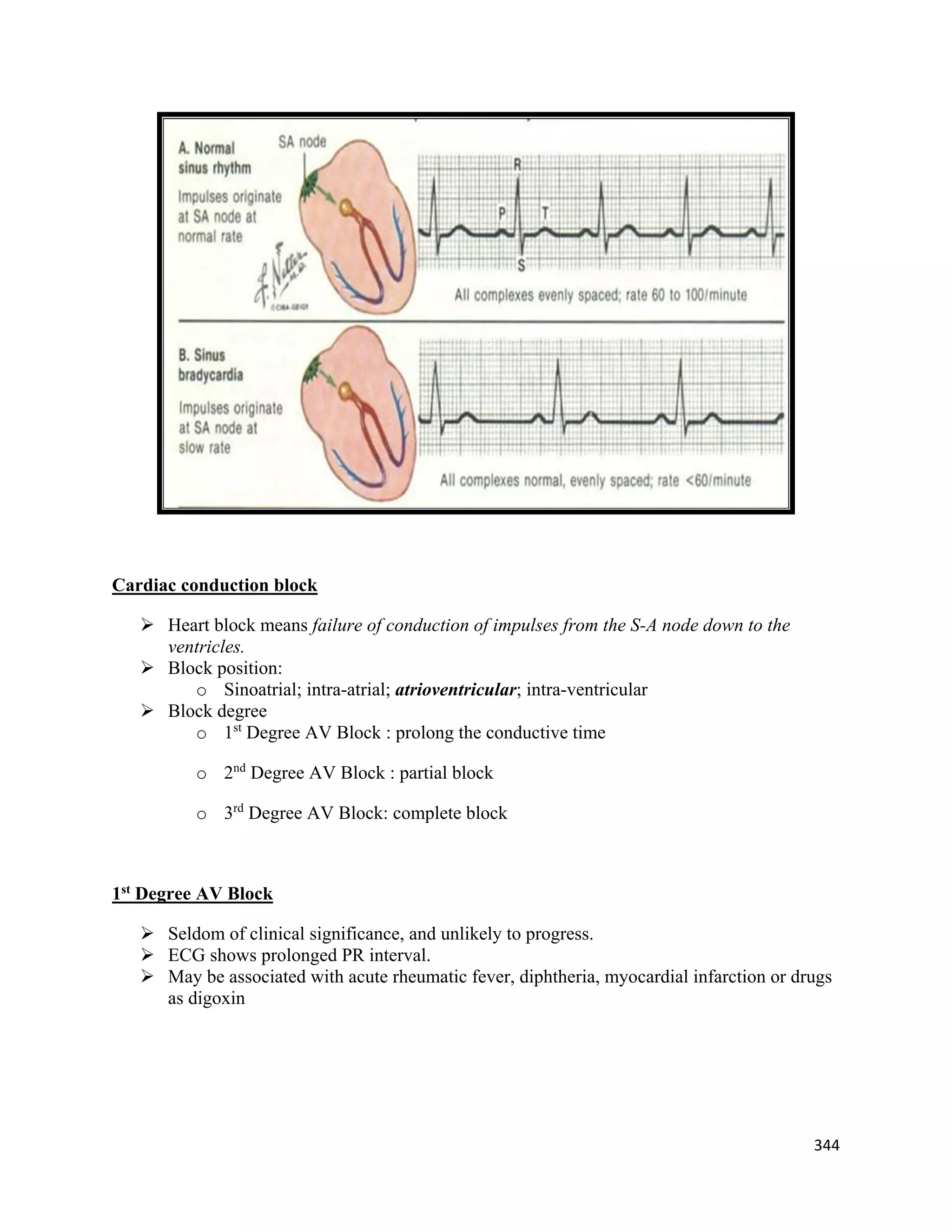 344 
 
Cardiac conduction block
 Heart block means failure of conduction of impulses from the S-A node down to the
ventricles.
 Block position:
o Sinoatrial; intra-atrial; atrioventricular; intra-ventricular
 Block degree
o 1st
Degree AV Block : prolong the conductive time
o 2nd
Degree AV Block : partial block
o 3rd
Degree AV Block: complete block
1st
Degree AV Block
 Seldom of clinical significance, and unlikely to progress.
 ECG shows prolonged PR interval.
 May be associated with acute rheumatic fever, diphtheria, myocardial infarction or drugs
as digoxin
 