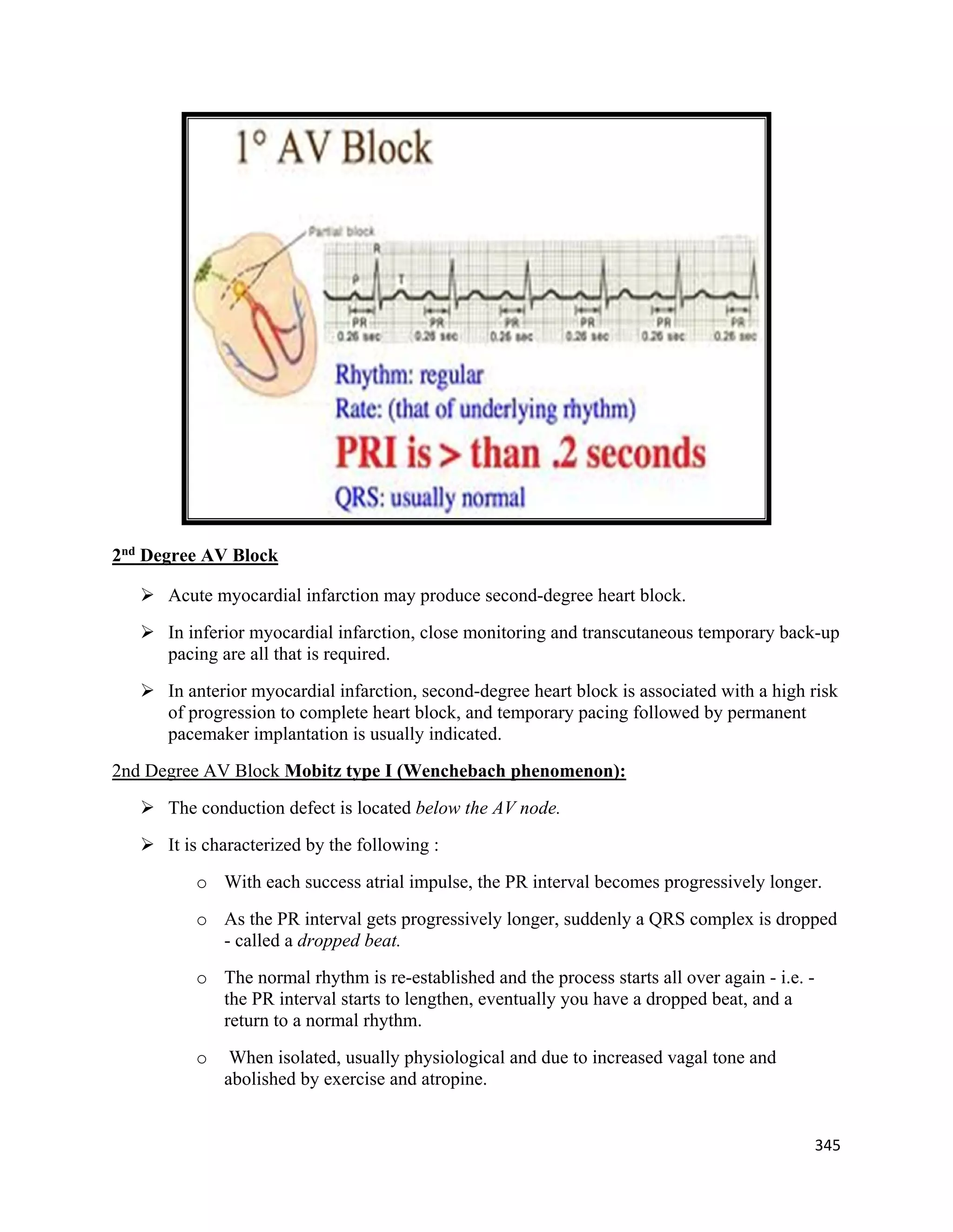 345 
 
2nd
Degree AV Block
 Acute myocardial infarction may produce second-degree heart block.
 In inferior myocardial infarction, close monitoring and transcutaneous temporary back-up
pacing are all that is required.
 In anterior myocardial infarction, second-degree heart block is associated with a high risk
of progression to complete heart block, and temporary pacing followed by permanent
pacemaker implantation is usually indicated.
2nd Degree AV Block Mobitz type I (Wenchebach phenomenon):
 The conduction defect is located below the AV node.
 It is characterized by the following :
o With each success atrial impulse, the PR interval becomes progressively longer.
o As the PR interval gets progressively longer, suddenly a QRS complex is dropped
- called a dropped beat.
o The normal rhythm is re-established and the process starts all over again - i.e. -
the PR interval starts to lengthen, eventually you have a dropped beat, and a
return to a normal rhythm.
o When isolated, usually physiological and due to increased vagal tone and
abolished by exercise and atropine.
 