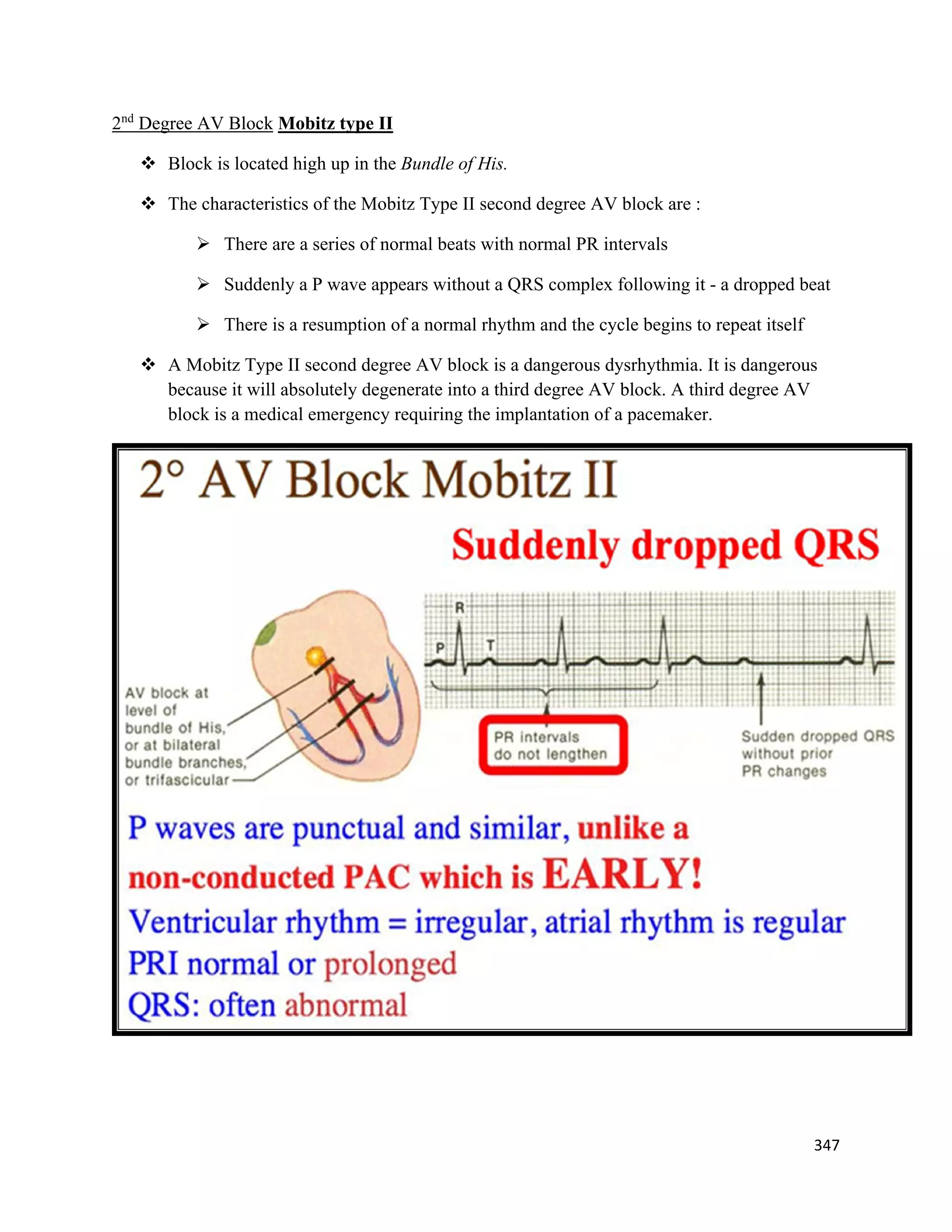 347 
 
2nd
Degree AV Block Mobitz type II
 Block is located high up in the Bundle of His.
 The characteristics of the Mobitz Type II second degree AV block are :
 There are a series of normal beats with normal PR intervals
 Suddenly a P wave appears without a QRS complex following it - a dropped beat
 There is a resumption of a normal rhythm and the cycle begins to repeat itself
 A Mobitz Type II second degree AV block is a dangerous dysrhythmia. It is dangerous
because it will absolutely degenerate into a third degree AV block. A third degree AV
block is a medical emergency requiring the implantation of a pacemaker.
 