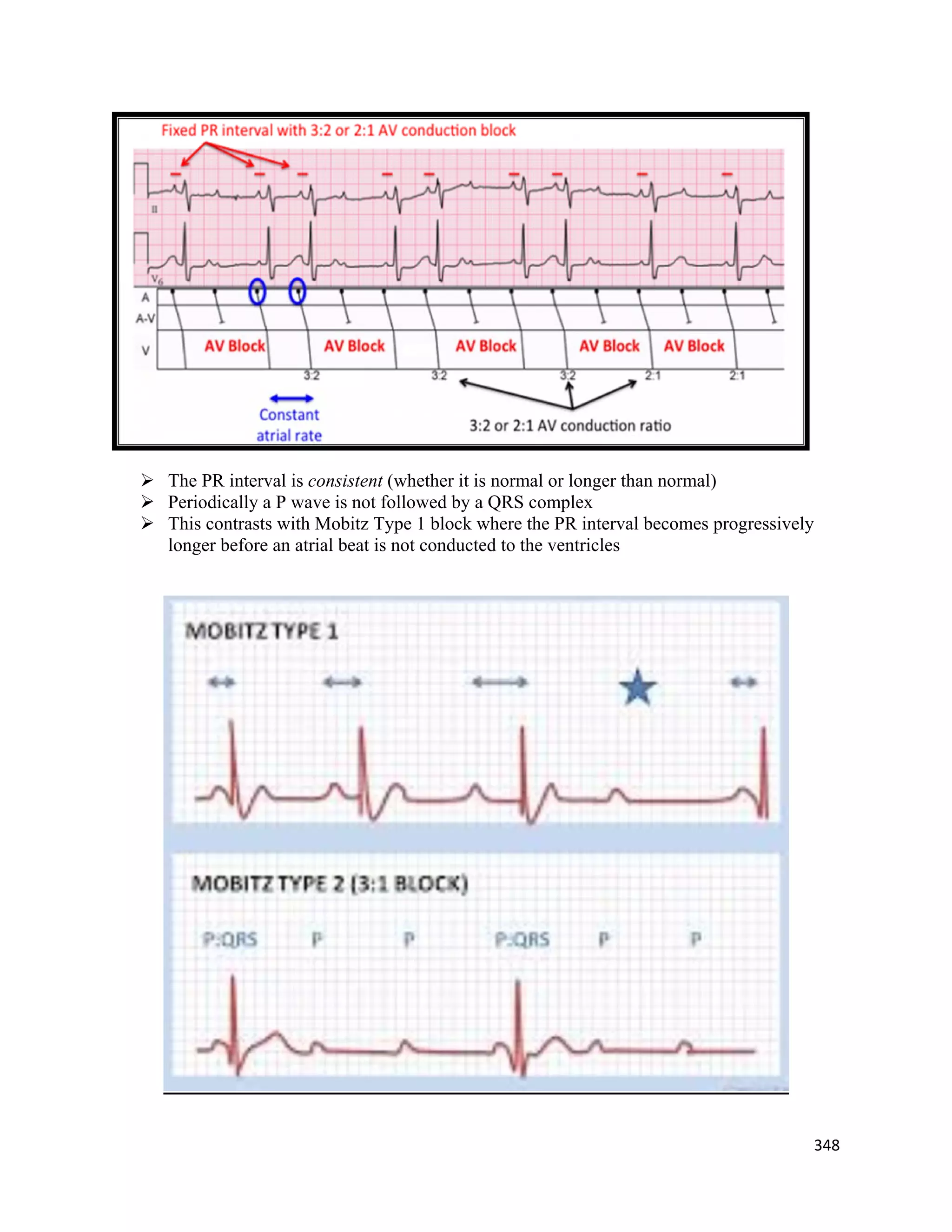 348 
 
 The PR interval is consistent (whether it is normal or longer than normal)
 Periodically a P wave is not followed by a QRS complex
 This contrasts with Mobitz Type 1 block where the PR interval becomes progressively
longer before an atrial beat is not conducted to the ventricles
 
