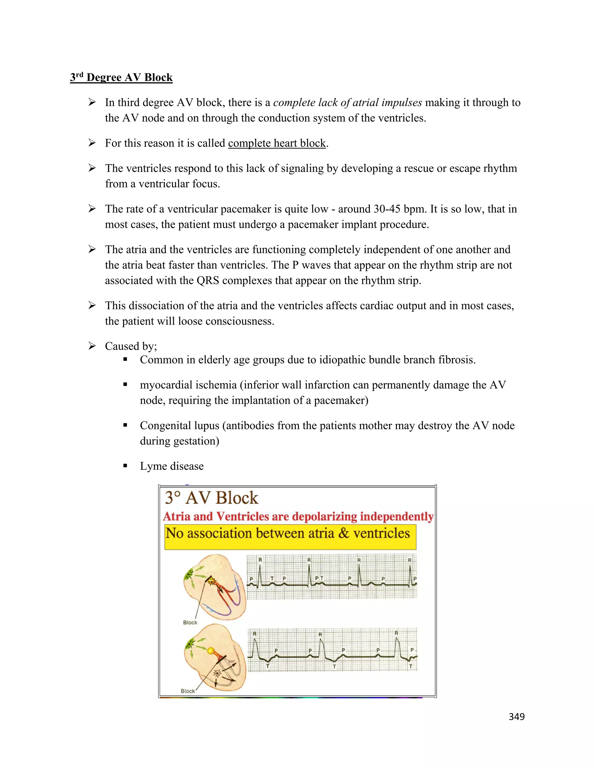 349 
 
3rd
Degree AV Block
 In third degree AV block, there is a complete lack of atrial impulses making it through to
the AV node and on through the conduction system of the ventricles.
 For this reason it is called complete heart block.
 The ventricles respond to this lack of signaling by developing a rescue or escape rhythm
from a ventricular focus.
 The rate of a ventricular pacemaker is quite low - around 30-45 bpm. It is so low, that in
most cases, the patient must undergo a pacemaker implant procedure.
 The atria and the ventricles are functioning completely independent of one another and
the atria beat faster than ventricles. The P waves that appear on the rhythm strip are not
associated with the QRS complexes that appear on the rhythm strip.
 This dissociation of the atria and the ventricles affects cardiac output and in most cases,
the patient will loose consciousness.
 Caused by;
 Common in elderly age groups due to idiopathic bundle branch fibrosis.
 myocardial ischemia (inferior wall infarction can permanently damage the AV
node, requiring the implantation of a pacemaker)
 Congenital lupus (antibodies from the patients mother may destroy the AV node
during gestation)
 Lyme disease
 