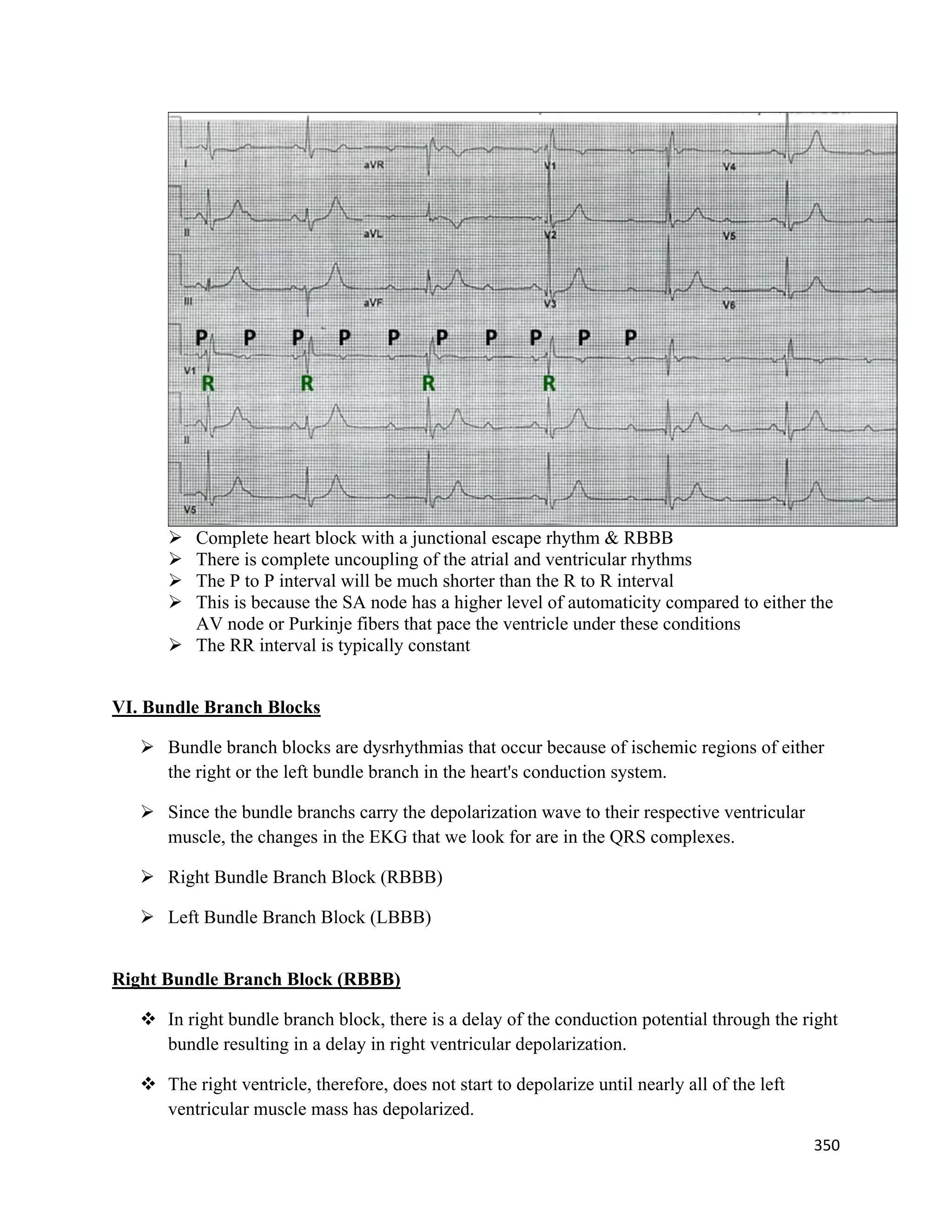 350 
 
 Complete heart block with a junctional escape rhythm & RBBB
 There is complete uncoupling of the atrial and ventricular rhythms
 The P to P interval will be much shorter than the R to R interval
 This is because the SA node has a higher level of automaticity compared to either the
AV node or Purkinje fibers that pace the ventricle under these conditions
 The RR interval is typically constant
VI. Bundle Branch Blocks
 Bundle branch blocks are dysrhythmias that occur because of ischemic regions of either
the right or the left bundle branch in the heart's conduction system.
 Since the bundle branchs carry the depolarization wave to their respective ventricular
muscle, the changes in the EKG that we look for are in the QRS complexes.
 Right Bundle Branch Block (RBBB)
 Left Bundle Branch Block (LBBB)
Right Bundle Branch Block (RBBB)
 In right bundle branch block, there is a delay of the conduction potential through the right
bundle resulting in a delay in right ventricular depolarization.
 The right ventricle, therefore, does not start to depolarize until nearly all of the left
ventricular muscle mass has depolarized.
 