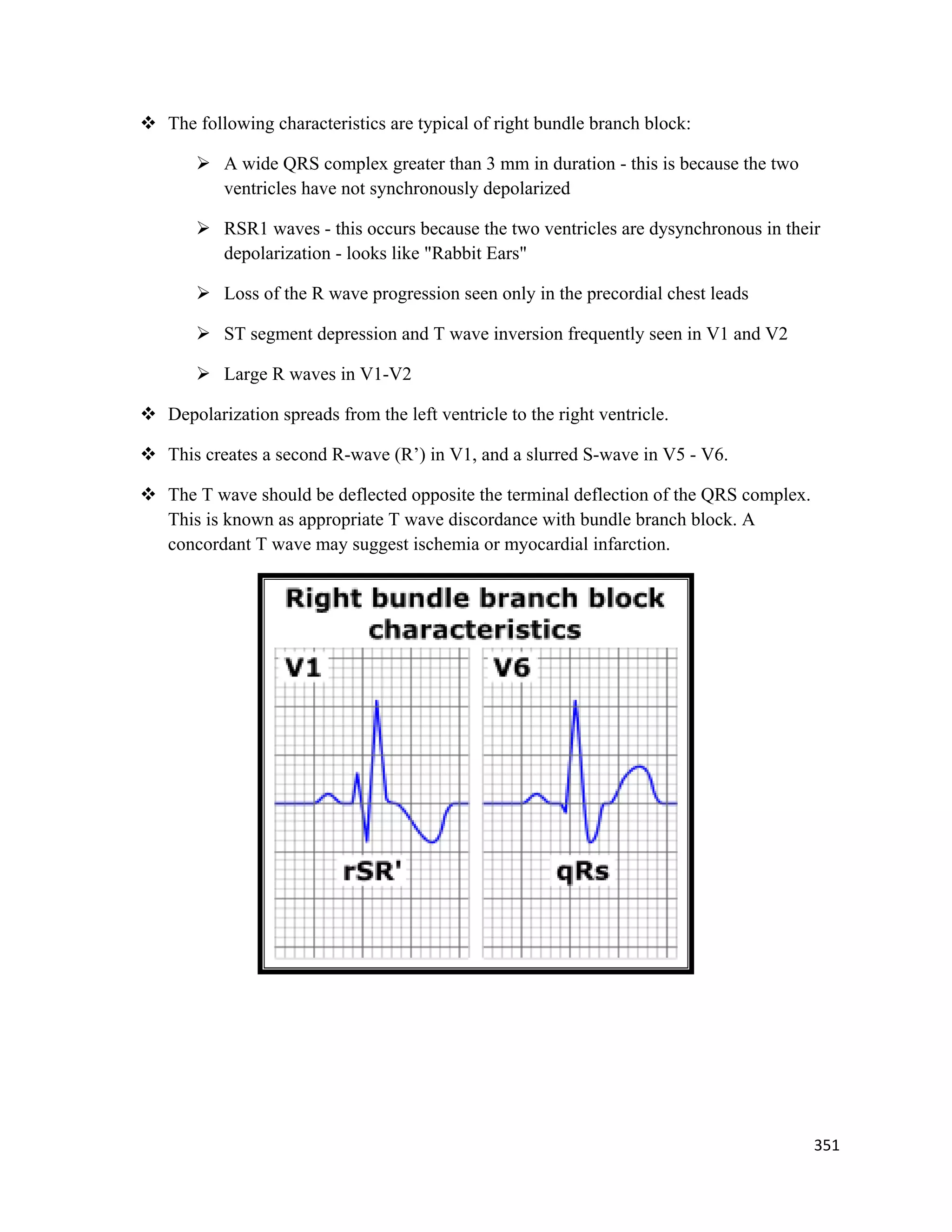 351 
 
 The following characteristics are typical of right bundle branch block:
 A wide QRS complex greater than 3 mm in duration - this is because the two
ventricles have not synchronously depolarized
 RSR1 waves - this occurs because the two ventricles are dysynchronous in their
depolarization - looks like "Rabbit Ears"
 Loss of the R wave progression seen only in the precordial chest leads
 ST segment depression and T wave inversion frequently seen in V1 and V2
 Large R waves in V1-V2
 Depolarization spreads from the left ventricle to the right ventricle.
 This creates a second R-wave (R’) in V1, and a slurred S-wave in V5 - V6.
 The T wave should be deflected opposite the terminal deflection of the QRS complex.
This is known as appropriate T wave discordance with bundle branch block. A
concordant T wave may suggest ischemia or myocardial infarction.
 