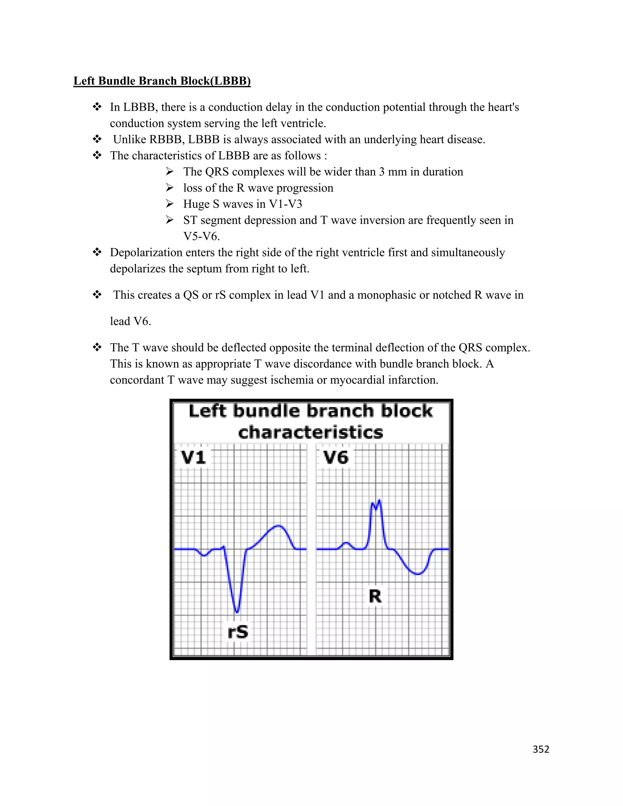 352 
 
Left Bundle Branch Block(LBBB)
 In LBBB, there is a conduction delay in the conduction potential through the heart's
conduction system serving the left ventricle.
 Unlike RBBB, LBBB is always associated with an underlying heart disease.
 The characteristics of LBBB are as follows :
 The QRS complexes will be wider than 3 mm in duration
 loss of the R wave progression
 Huge S waves in V1-V3
 ST segment depression and T wave inversion are frequently seen in
V5-V6.
 Depolarization enters the right side of the right ventricle first and simultaneously
depolarizes the septum from right to left.
 This creates a QS or rS complex in lead V1 and a monophasic or notched R wave in
lead V6.
 The T wave should be deflected opposite the terminal deflection of the QRS complex.
This is known as appropriate T wave discordance with bundle branch block. A
concordant T wave may suggest ischemia or myocardial infarction.
 