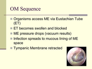 OM Sequence
 Organisms access ME via Eustachian Tube
(ET)
 ET becomes swollen and blocked
 ME pressure drops (vacuum results)
 Infection spreads to mucous lining of ME
space
 Tympanic Membrane retracted
 